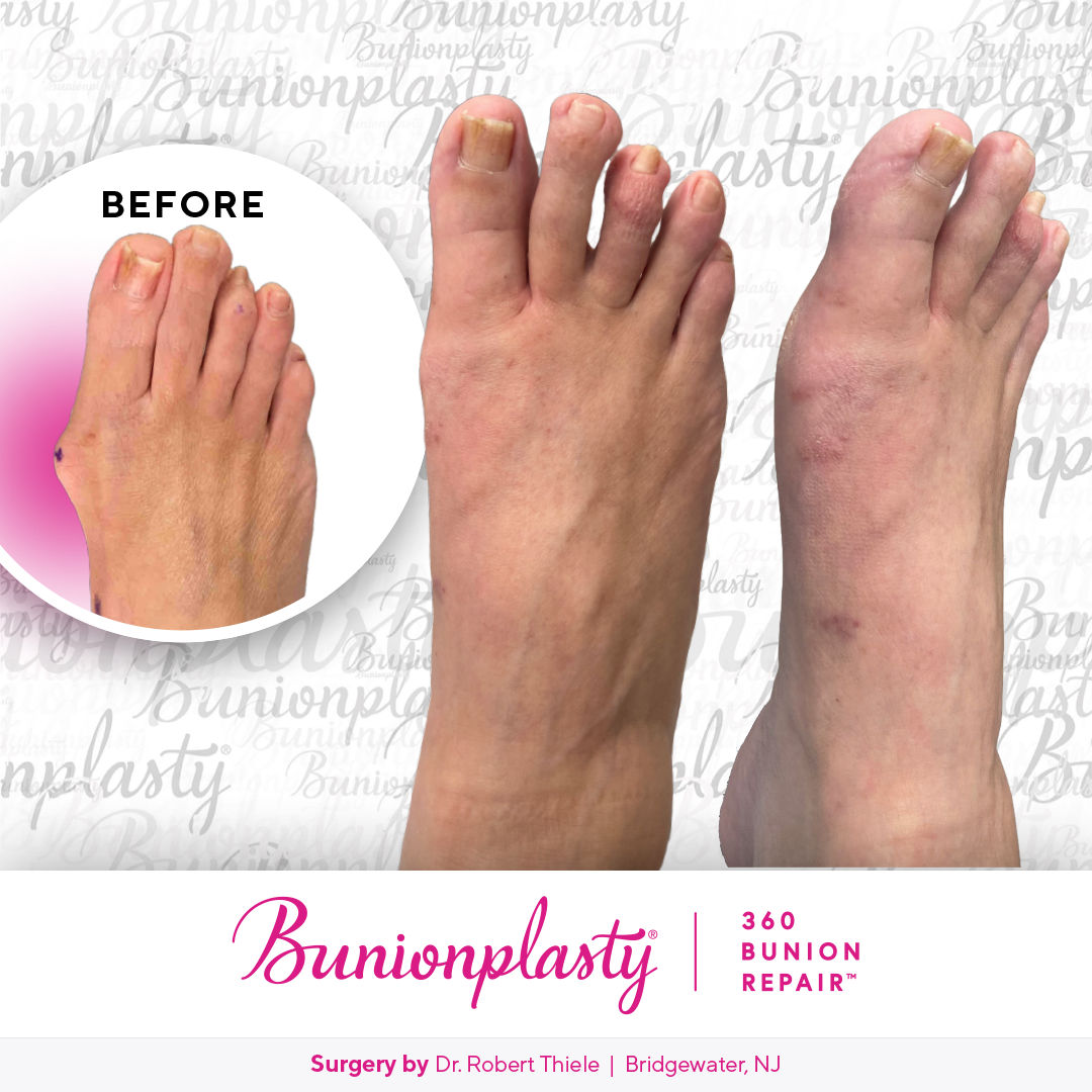 Bunionplasty® Before & After  |  Dr. Robert Thiele  |  Large Bunion  |  Right Foot