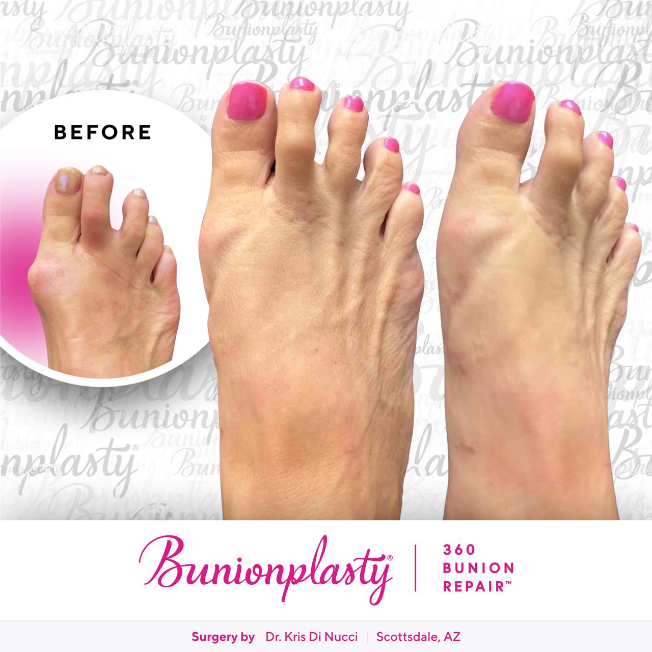 Bunionplasty® Before & After  |  Dr. Kris Di Nucci  |  Large Bunion  |  Right Foot