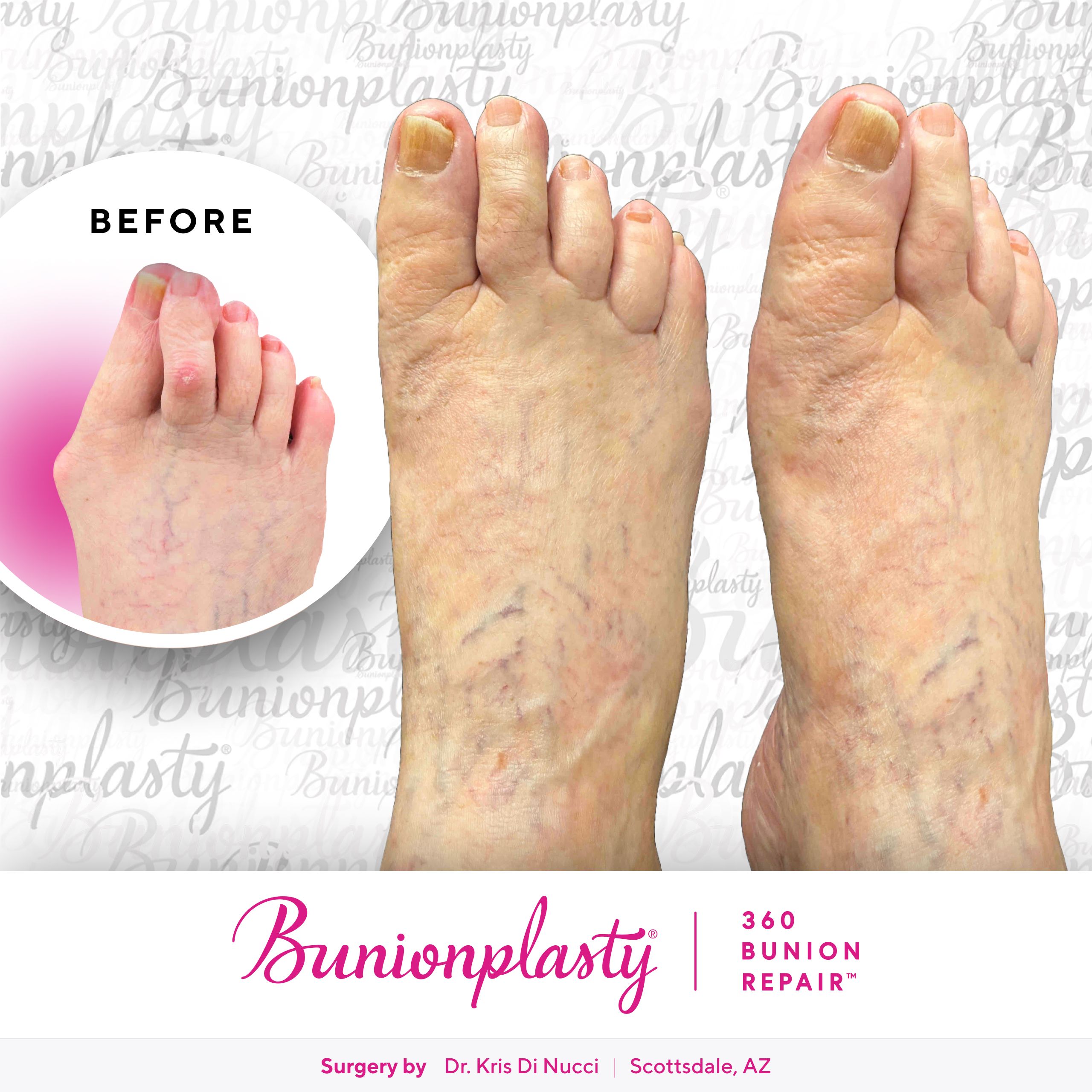 Bunionplasty® Before & After  |  Dr. Kris Di Nucci  |  Severe Bunion  |  Right Foot