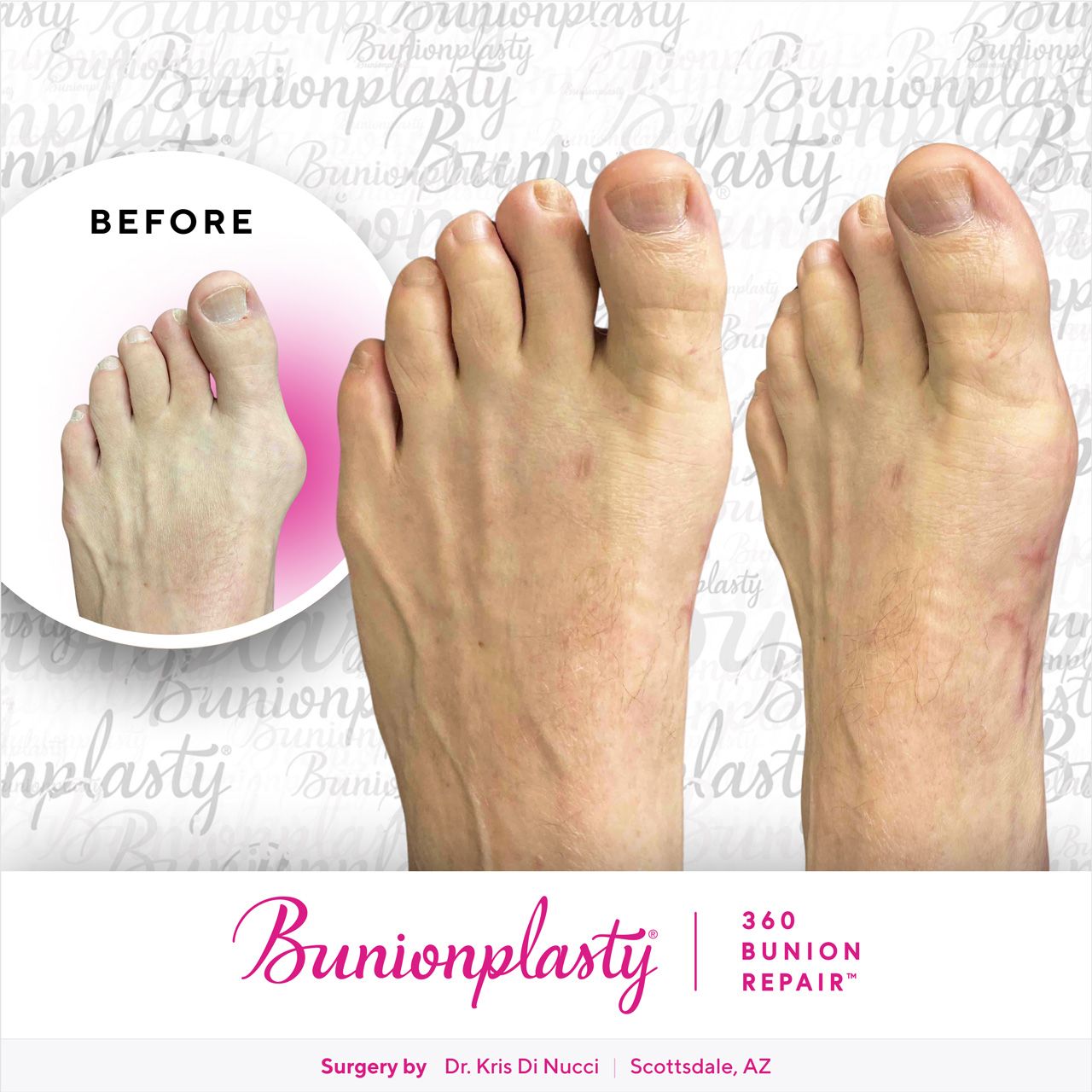 Bunionplasty® Before & After  |  Dr. Kris Di Nucci  |  Large Bunion  |  Left Foot