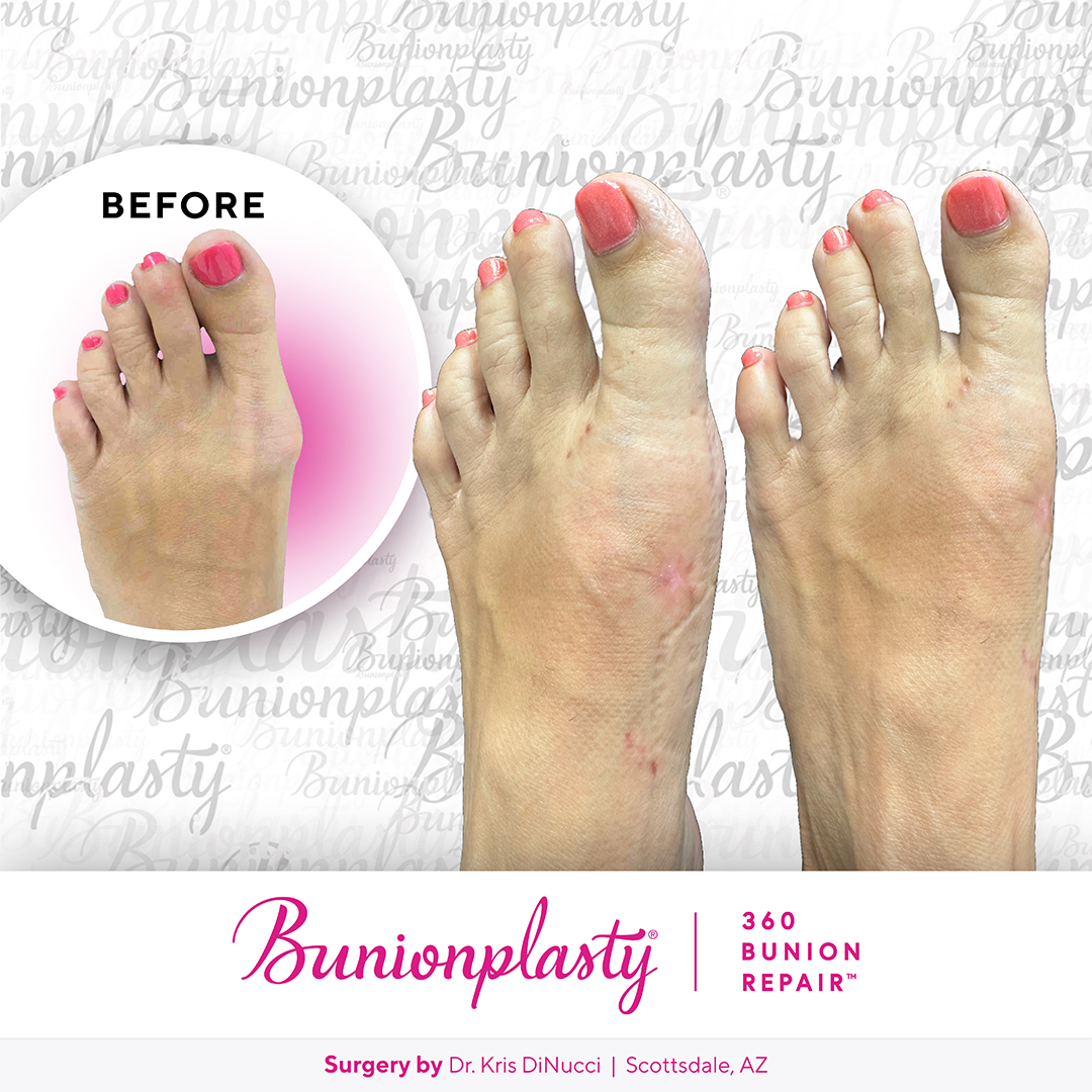 Bunionplasty® Before & After  |  Dr. Kris Di Nucci  |  Mild Bunion  |  Left Foot