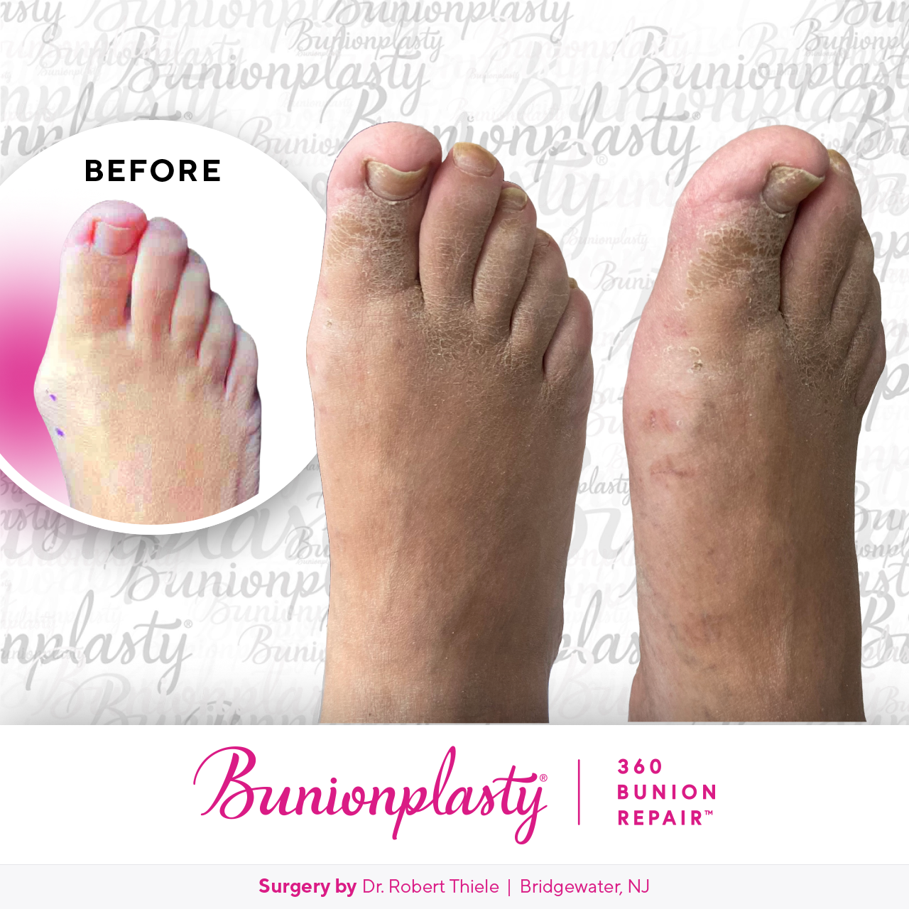 Bunionplasty® Before & After  |  Dr. Robert Thiele  |  Large Bunion  |  Right Foot