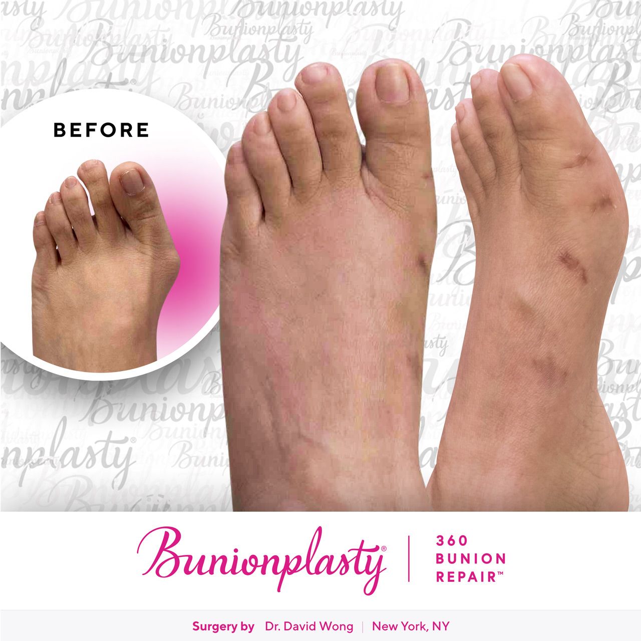 Bunionplasty® Before & After |  Dr. David Wong  |  Large Bunion  |  Left Foot