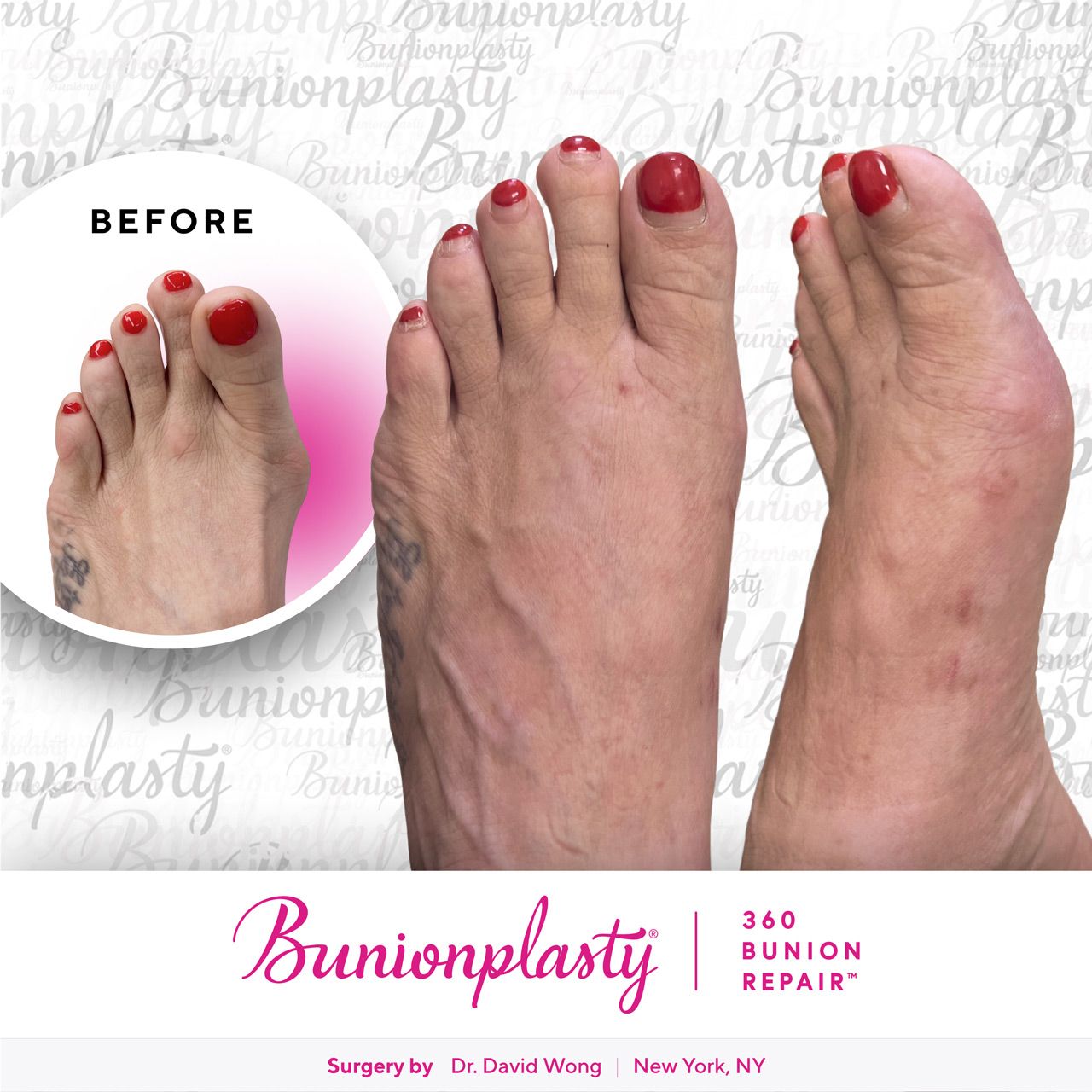 Bunionplasty® Before & After |  Large Bunion  |  Left Foot