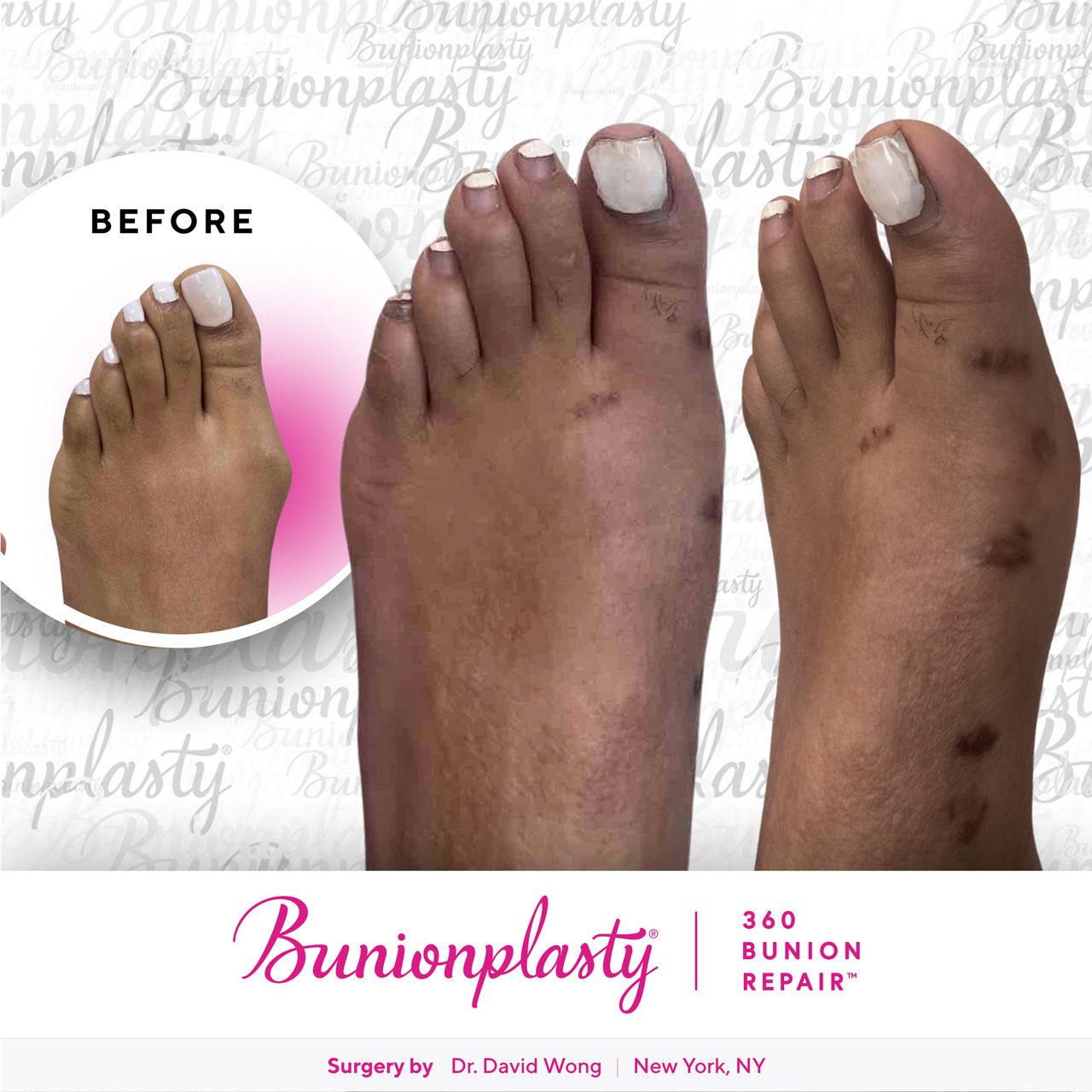 Bunionplasty® Before & After | Mild Bunion | Left Foot
