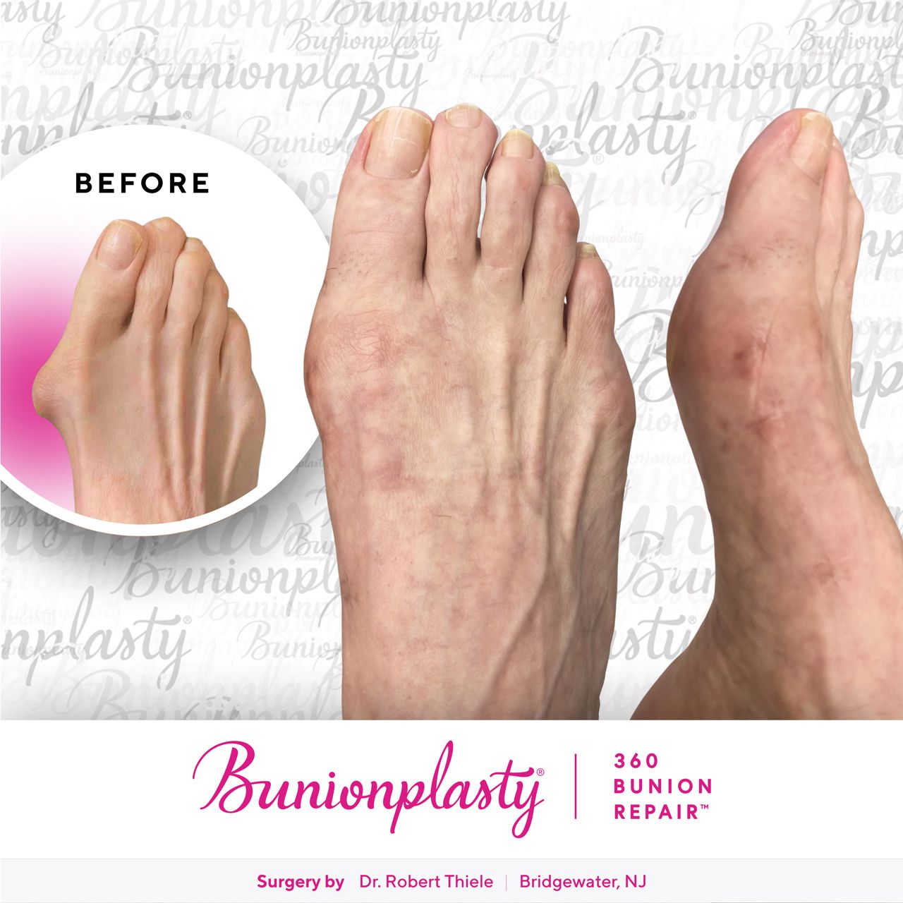 Bunionplasty® Before & After  |  Dr. Robert Thiele  |  Severe Bunion  |  Right Foot