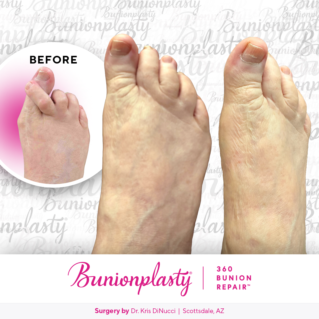 Bunionplasty® Before & After  |  Dr. Kris Di Nucci  |  Severe Bunion  |  Right Foot