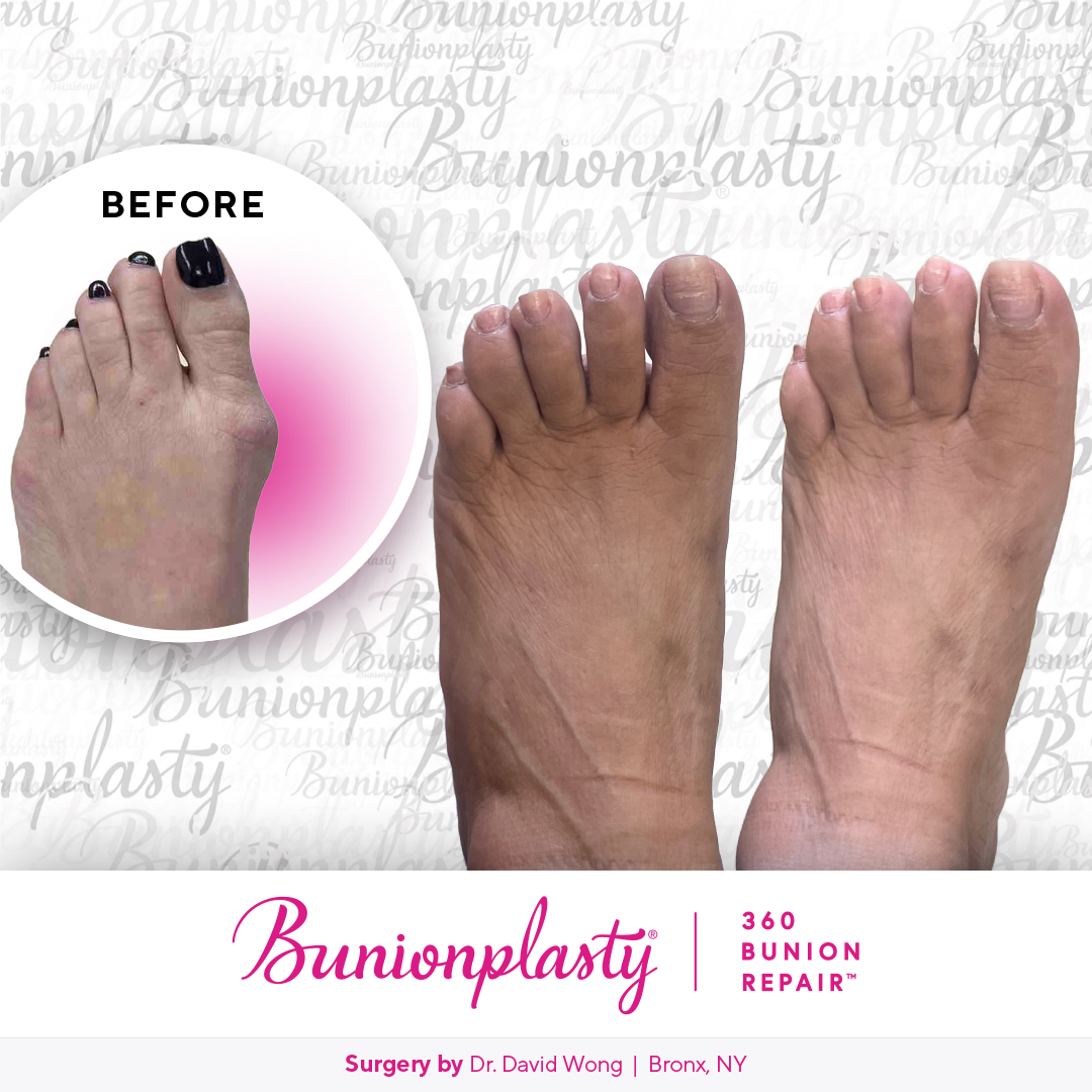 Bunionplasty® Before & After  |  Dr. David Wong |  Large Bunion  |  Left Foot