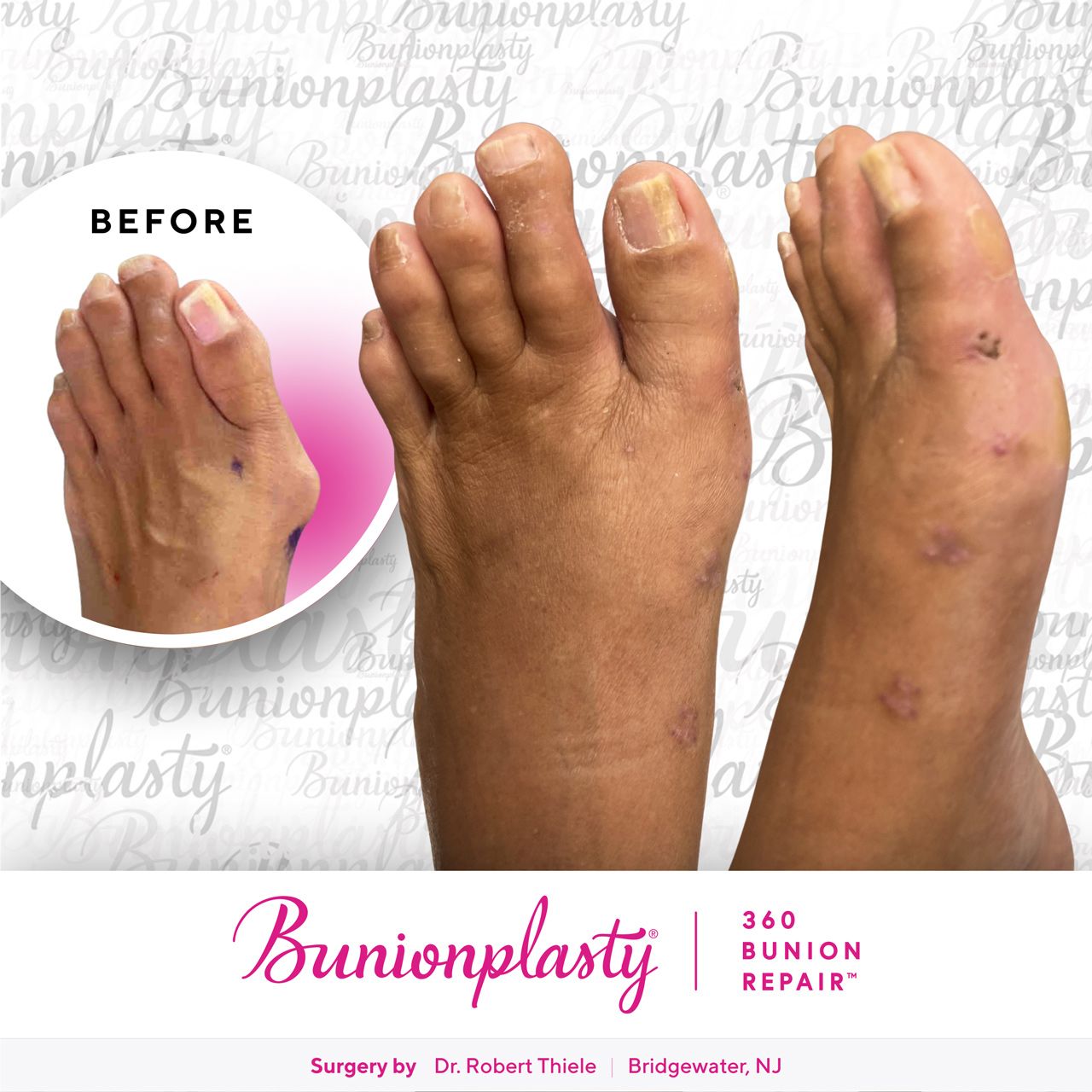 Bunionplasty® Before & After  |  Dr. Robert Thiele  |  Severe Bunion  |  Left Foot