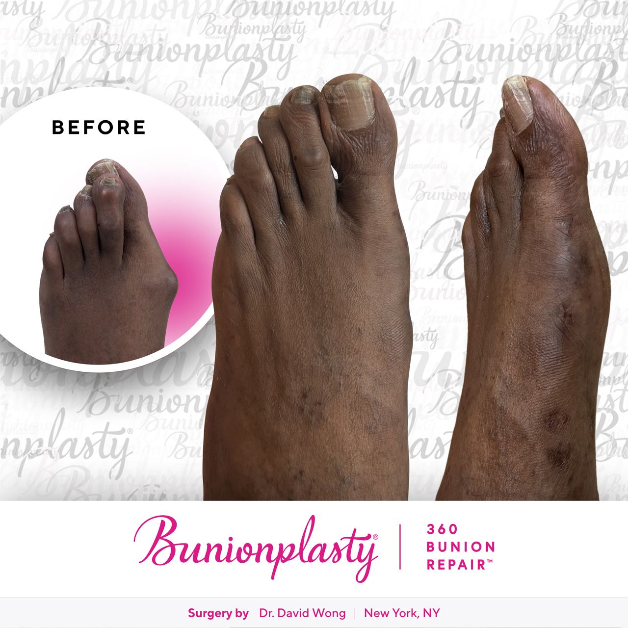 Bunionplasty® Before & After |  Severe Bunion  |  Left Foot