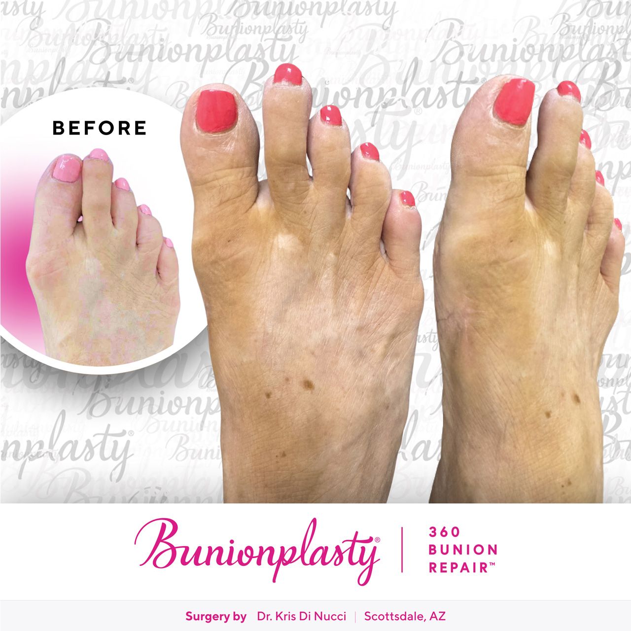 Bunionplasty® Before & After  |  Dr. Kris Di Nucci  |  Mild Bunion  |  Right Foot