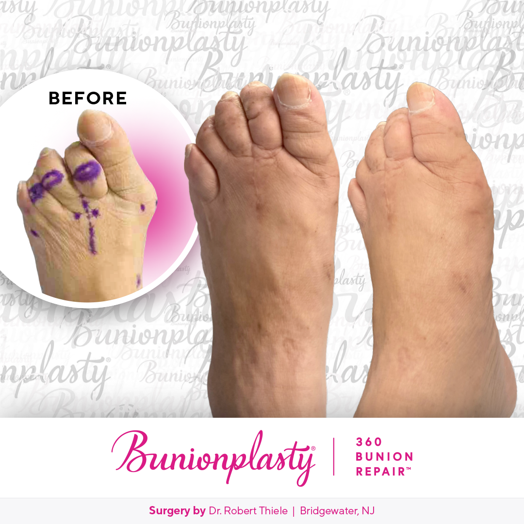 Bunionplasty® Before & After  |  Dr. Robert Thiele  |  Severe Bunion  |  Left Foot