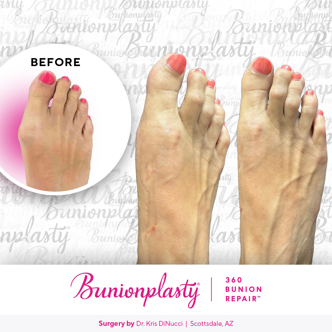 Bunionplasty® Before & After  |  Dr. Kris Di Nucci  |  Mild Bunion  |  Right Foot