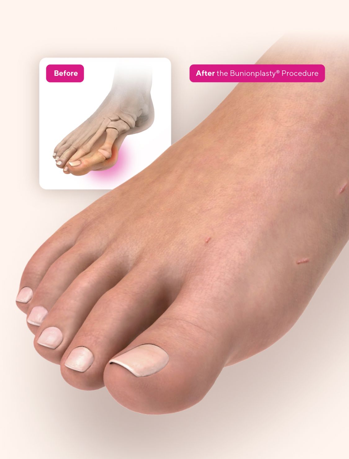 Voom™ Medical Devices’ Bunionplasty® 360 Bunion Repair™ Solution Offers Modern Alternative to Traditional 3D Approaches