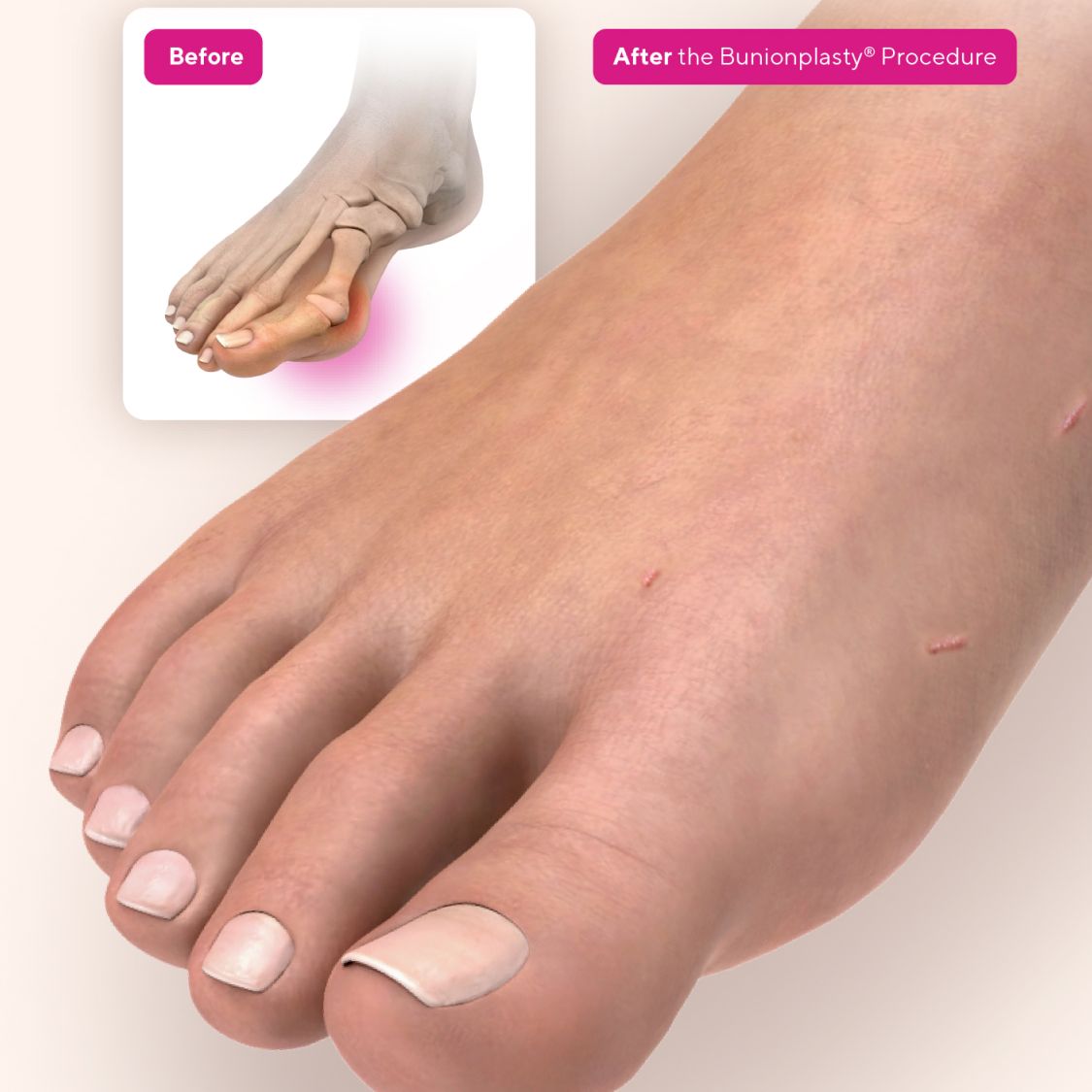 Voom™ Medical Devices’ Bunionplasty® 360 Bunion Repair™ Solution Offers Modern Alternative to Traditional 3D Approaches
