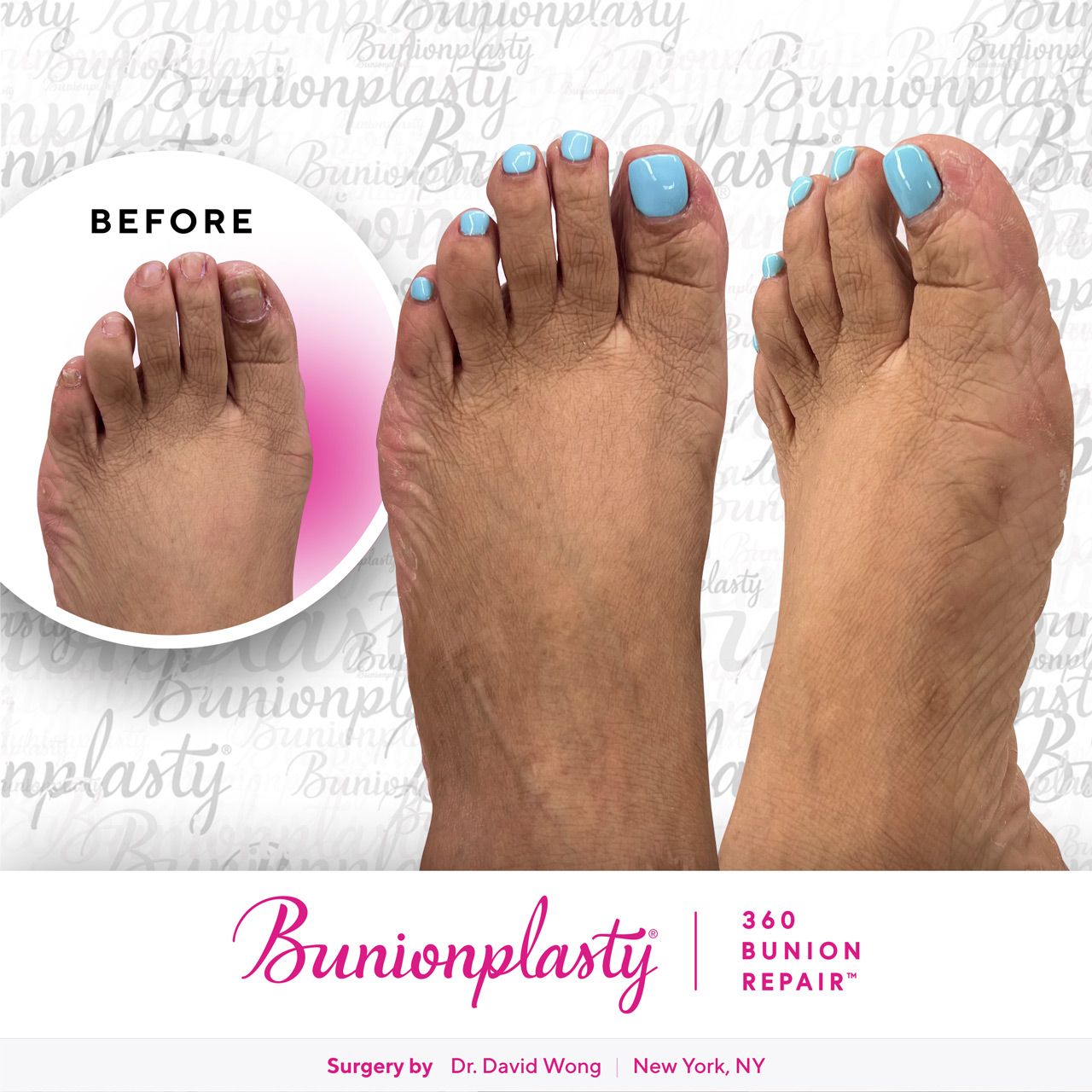 Bunionplasty® Before & After |  Mild Bunion  |  Left Foot