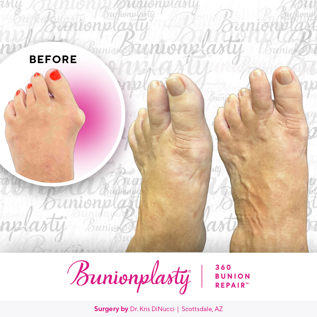Bunionplasty® Before & After  |  Dr. Kris Di Nucci  |  Severe Bunion  |  Left Foot