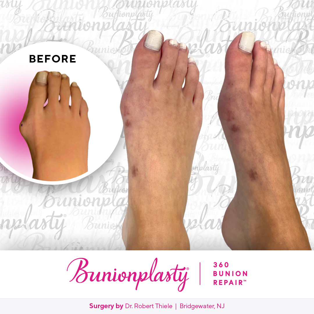 Bunionplasty® Before & After  |  Dr. Robert Thiele  |  Large Bunion  |  Right Foot