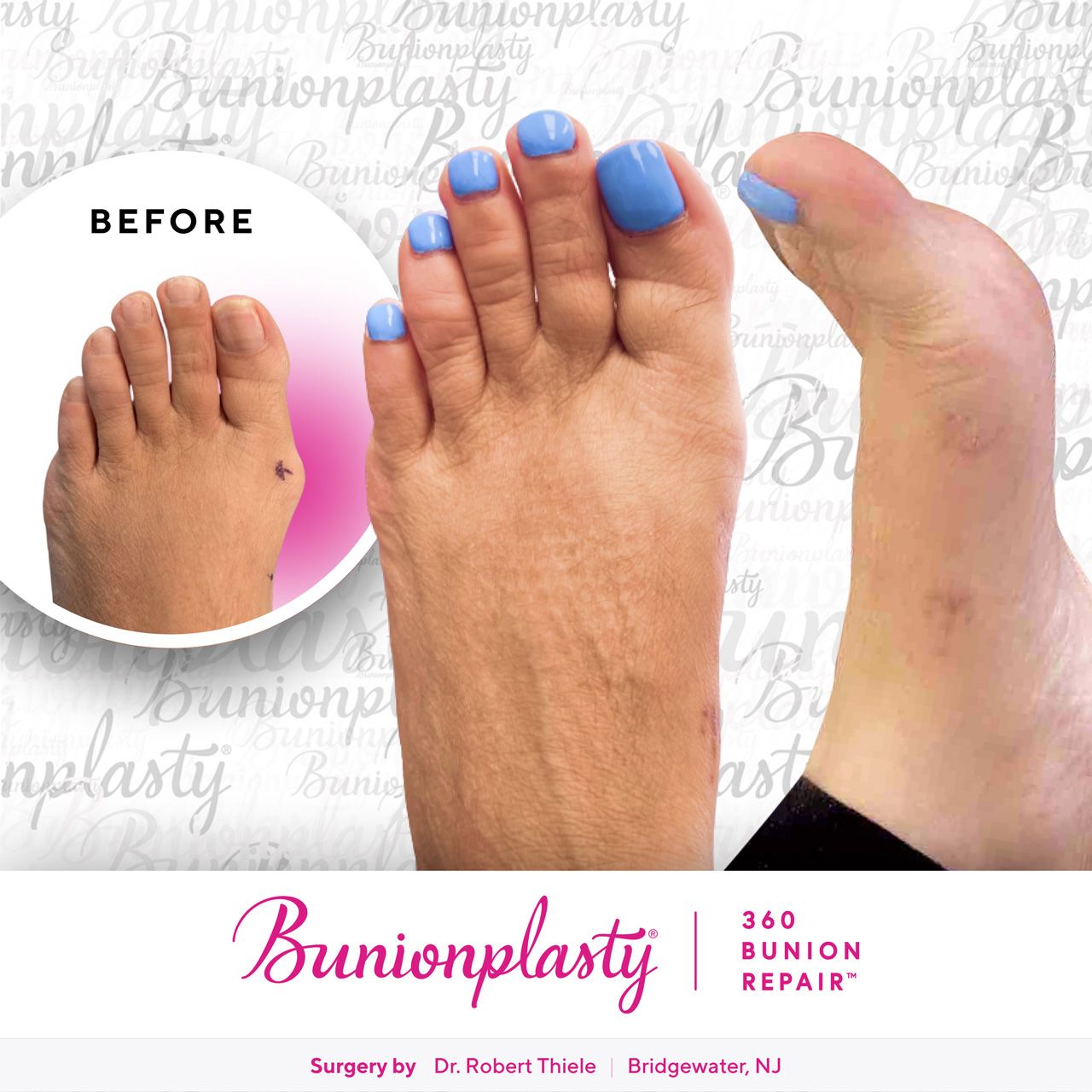 Bunionplasty® Before & After  |  Dr. Robert Thiele  |  Mild Bunion  |  Left Foot