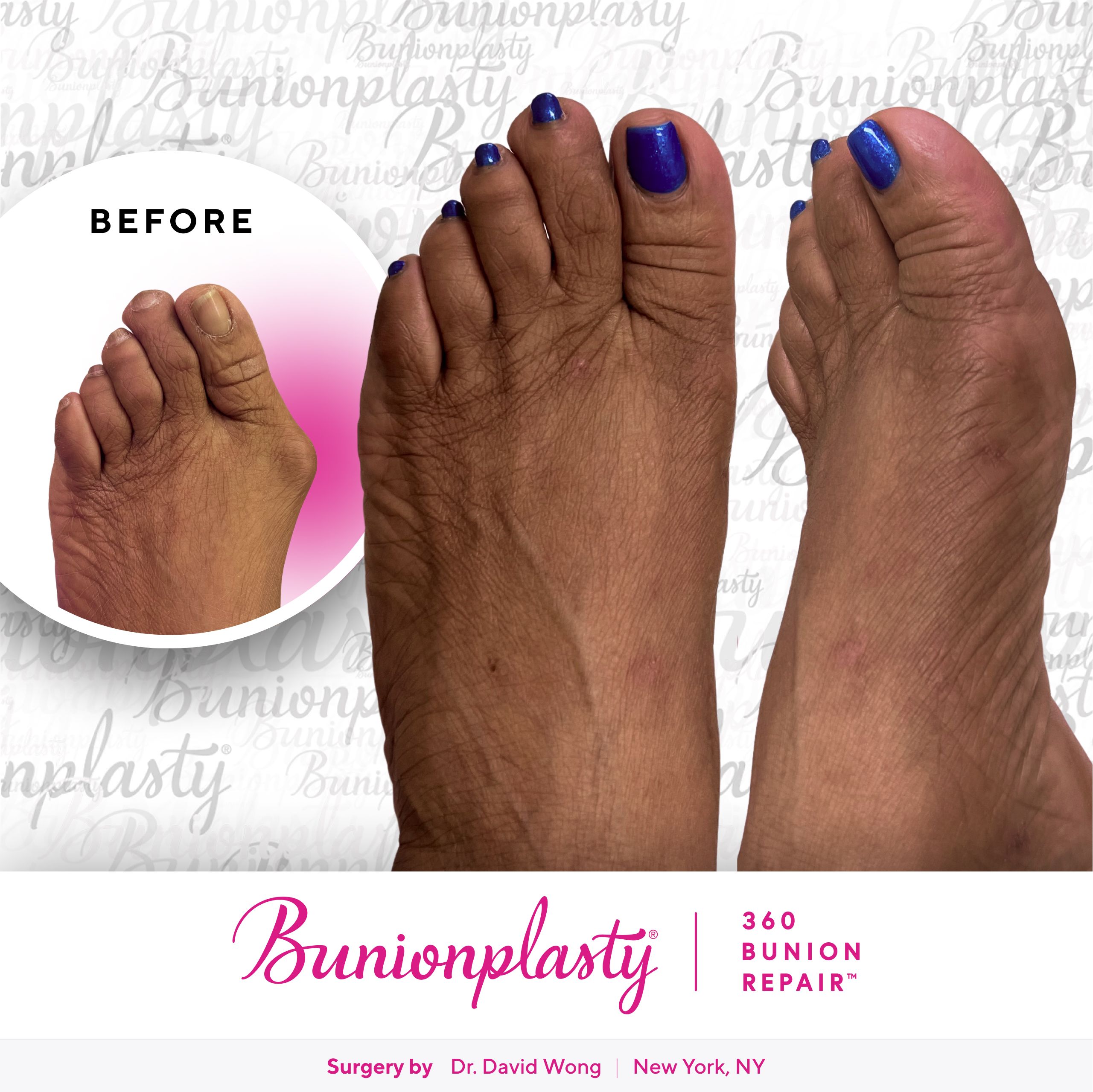 Bunionplasty® Before & After |  Dr. David Wong  |  Severe Bunion  |  Left Foot