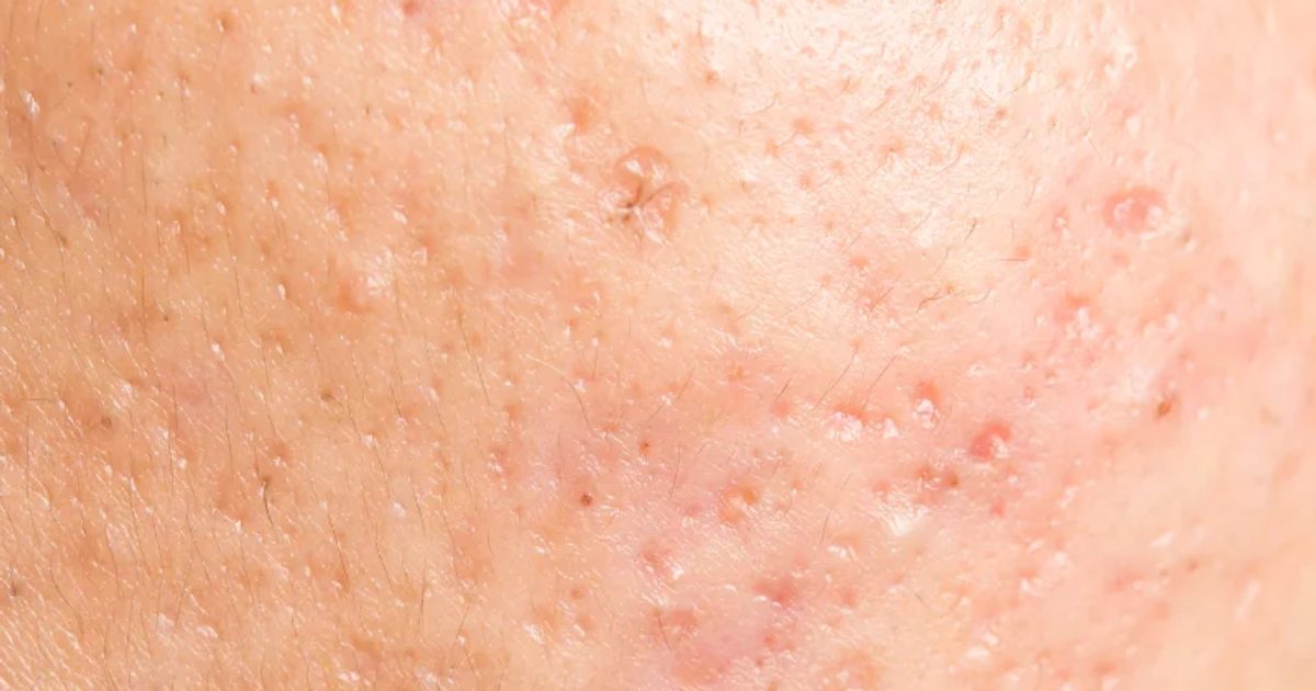 can retatrutide cause acne TRT Side Effects: Managing and Fluid Retention Retatrutide Side Effects: What Clinical