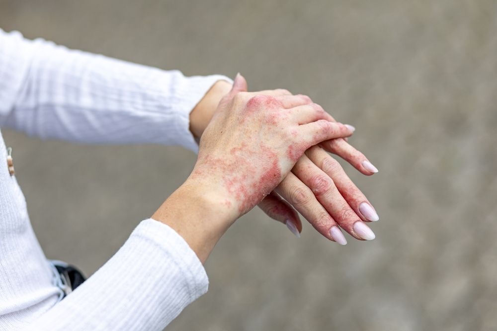 Detailed view of red, inflamed, and scaly skin patches on a person’s hands, illustrating lesions that may require a biopsy to rule out CTCL.