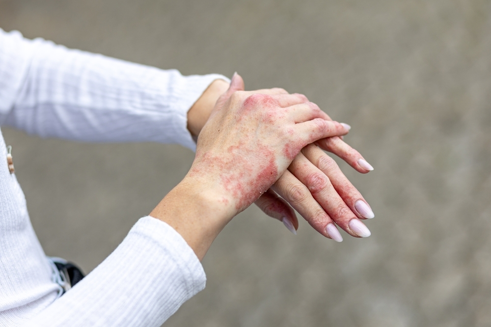 Image Detailed view of red, inflamed, and scaly skin patches on a person’s hands, illustrating lesions that may require a biopsy to rule out CTCL.