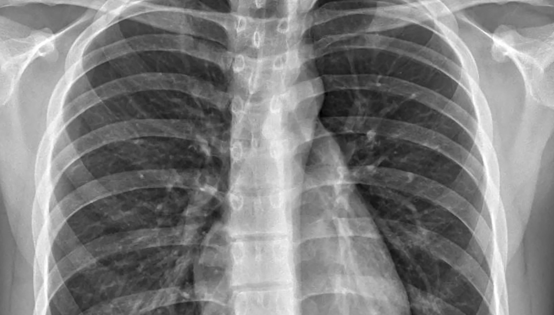 Image Chest X-ray