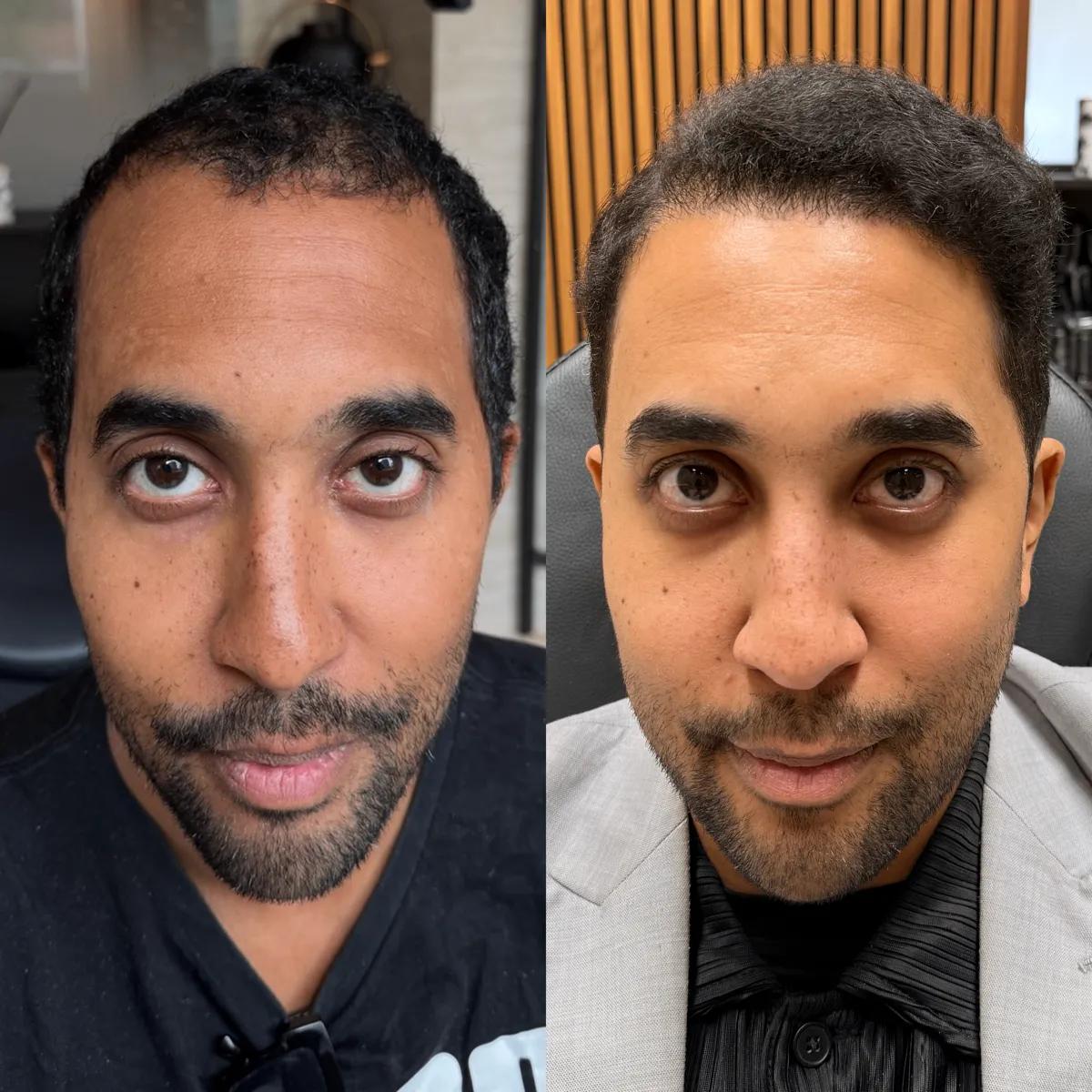 Före och efter hårtransplantation — patient i ålder 50+, resultat efter 12 mån.