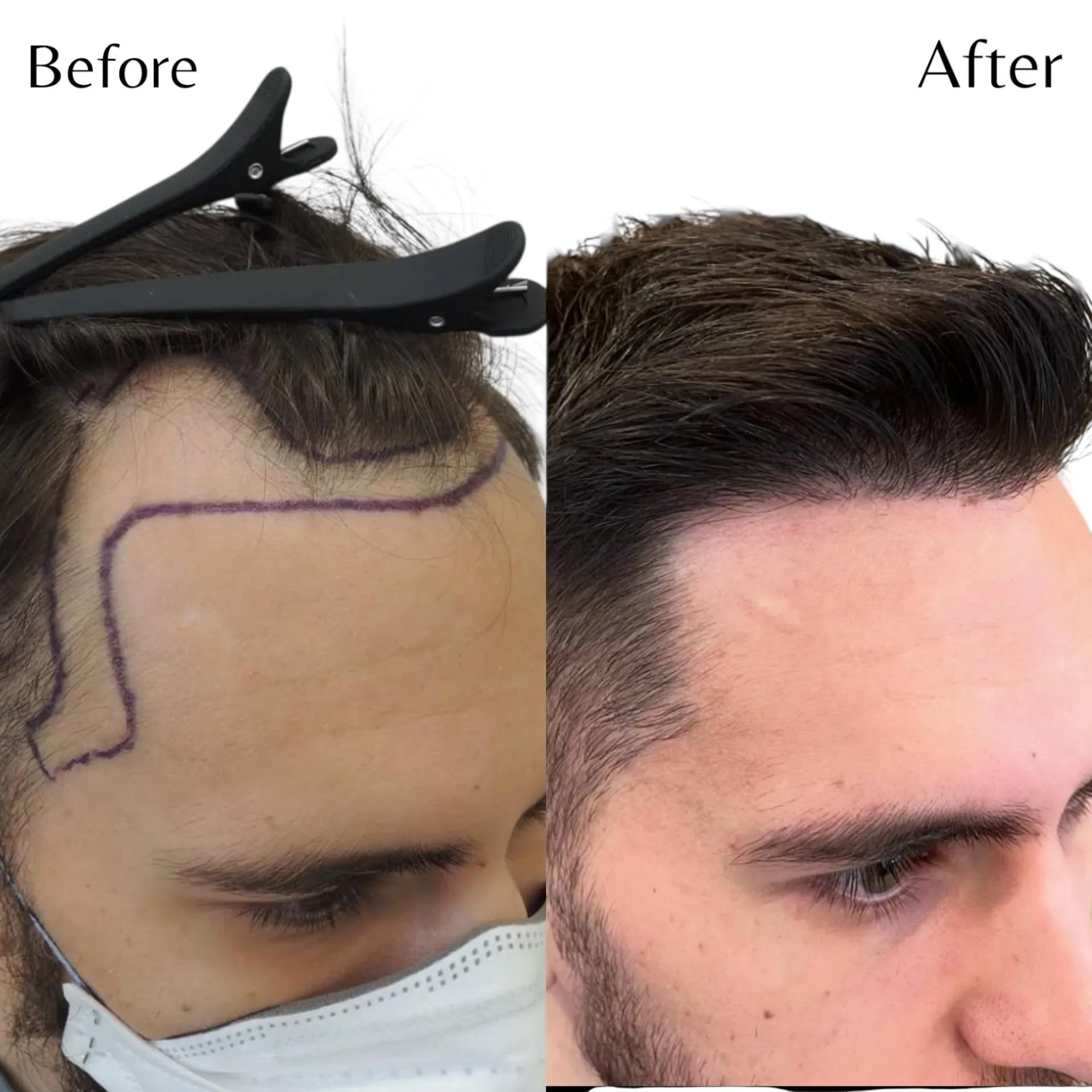 Före och efter hårtransplantation — patient i ålder 18–29, resultat efter 9 mån.