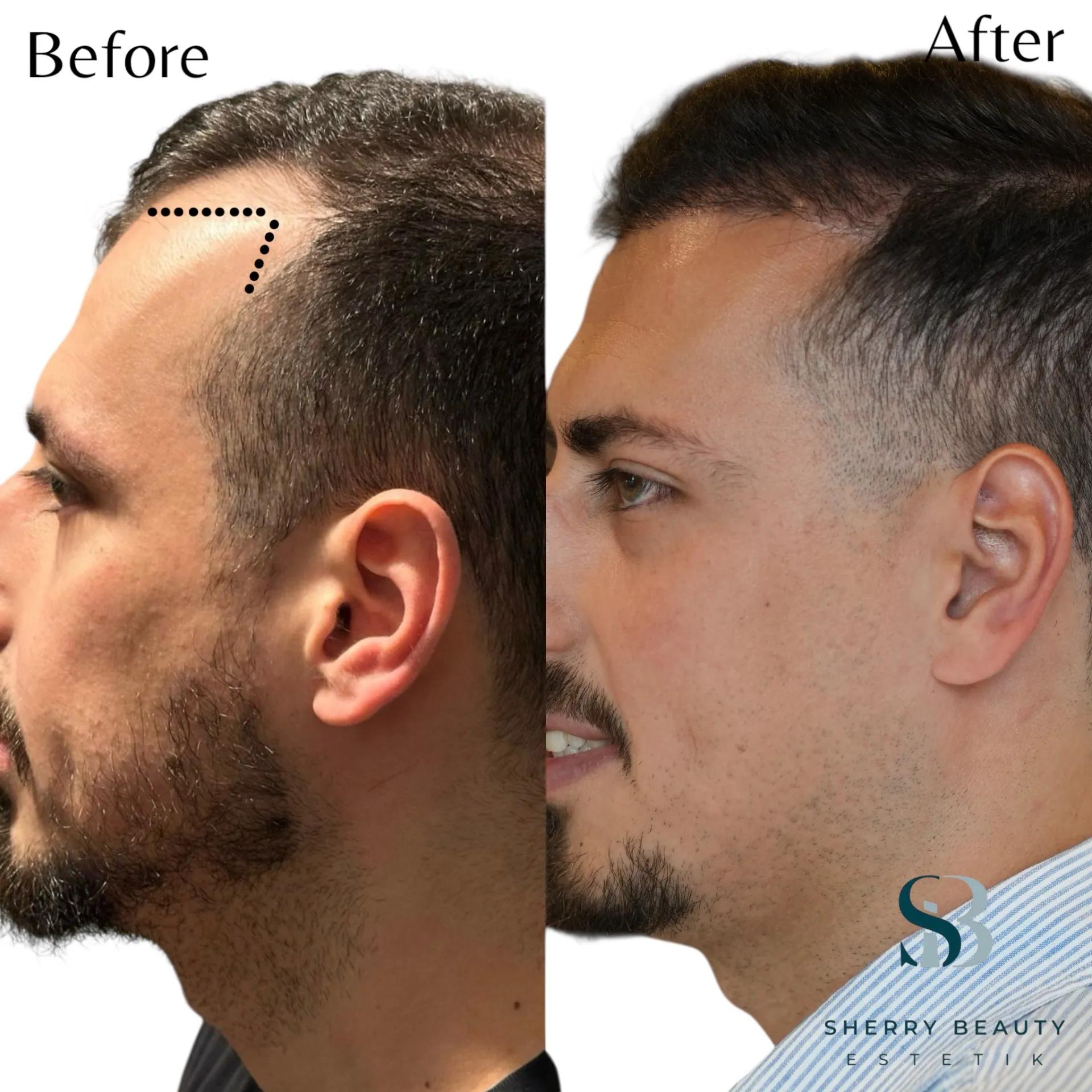 Före och efter hårtransplantation — patient i ålder 30–49, resultat efter 12 mån.