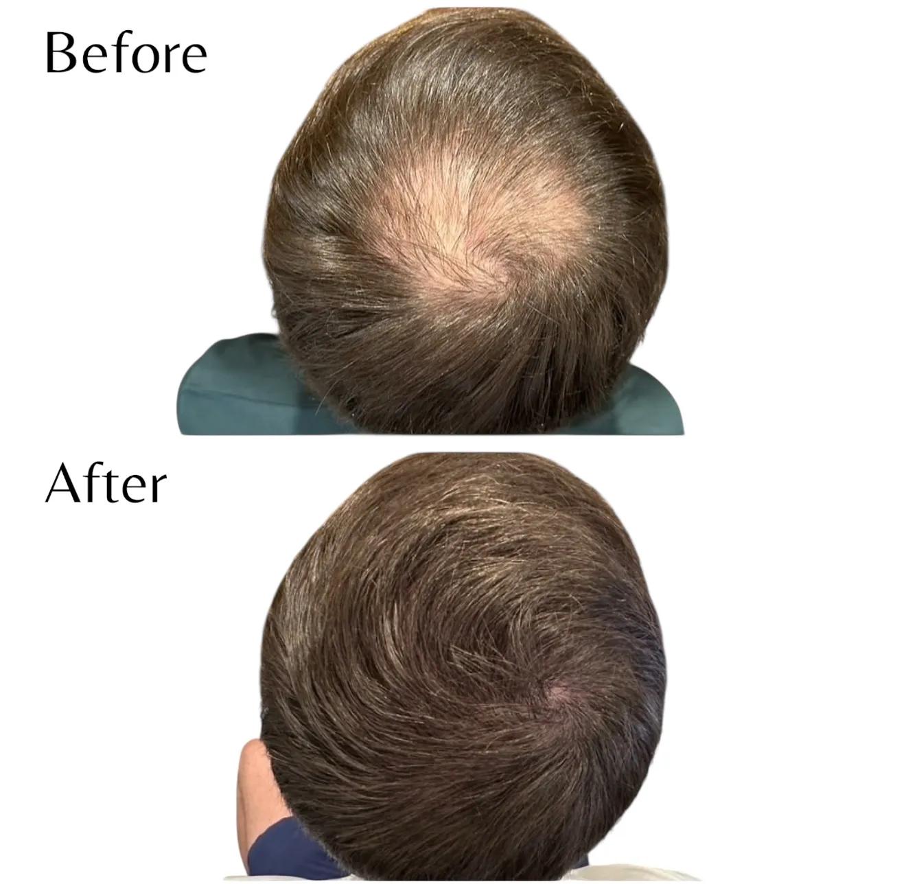 Före och efter hårtransplantation — patient i ålder 30–49, resultat efter 12 mån.