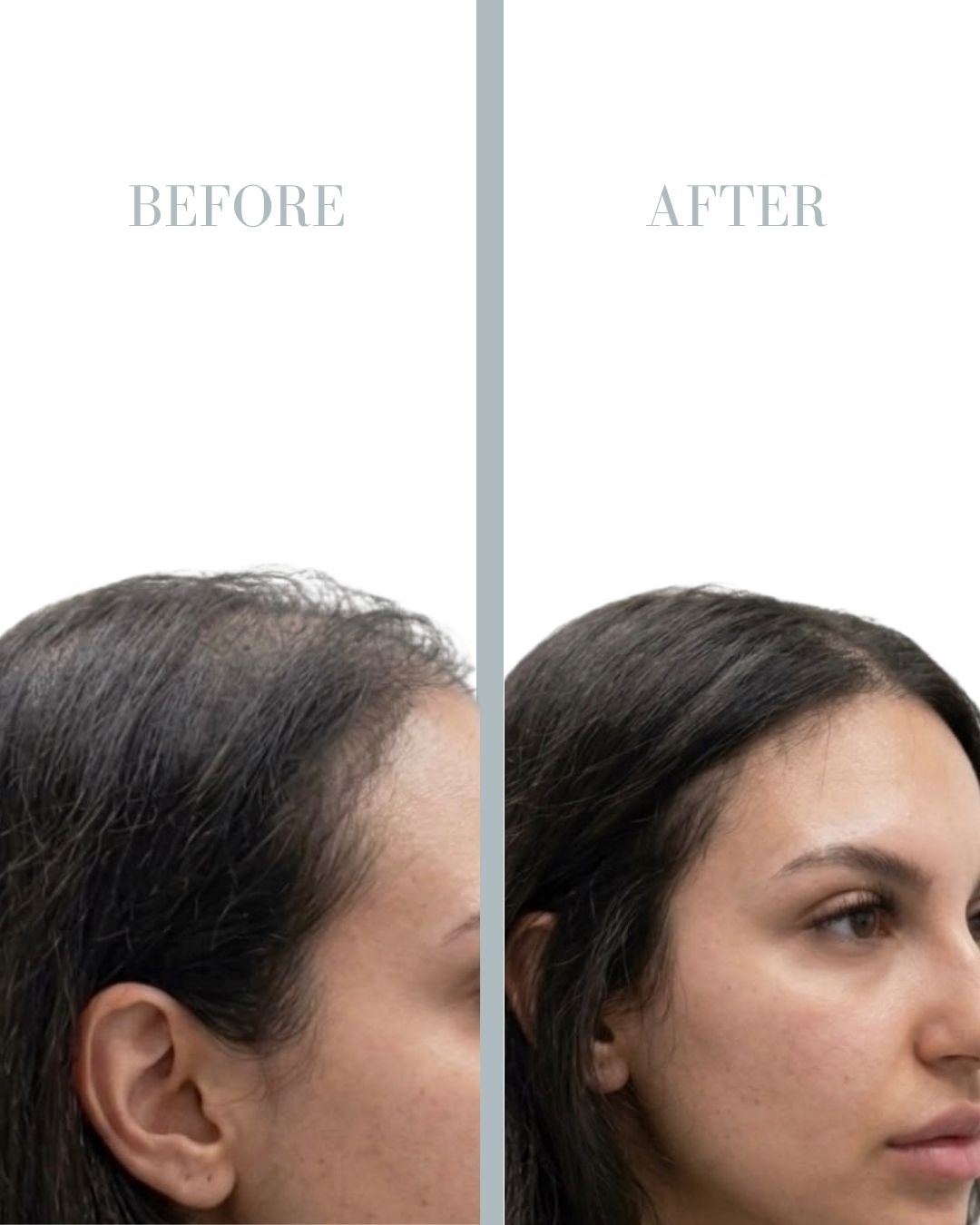 Before and after PRP.