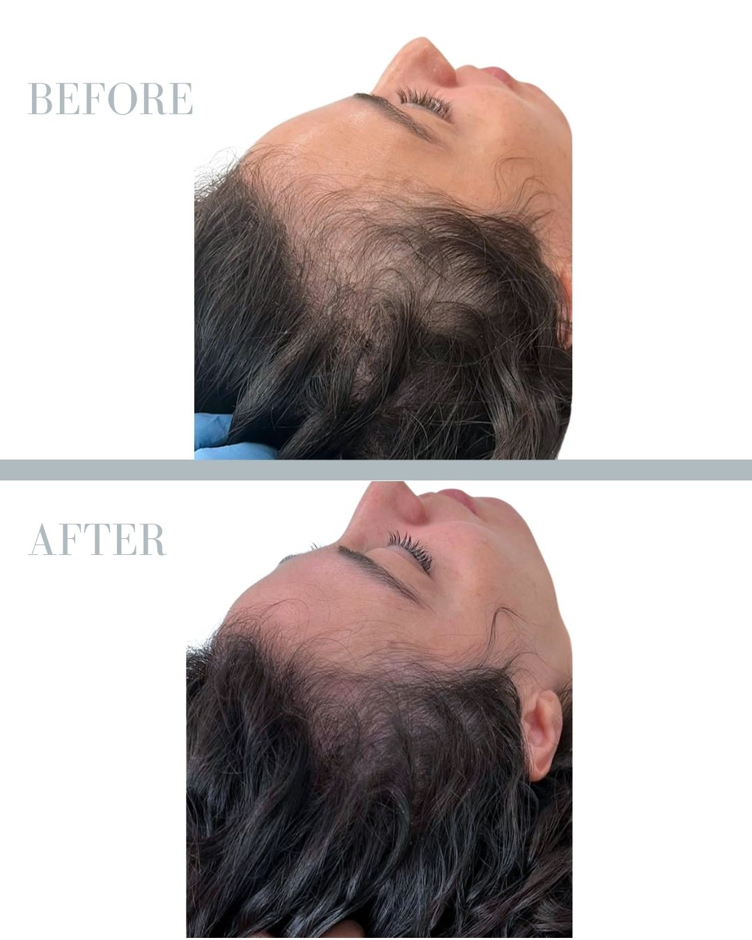 Before and after PRP.
