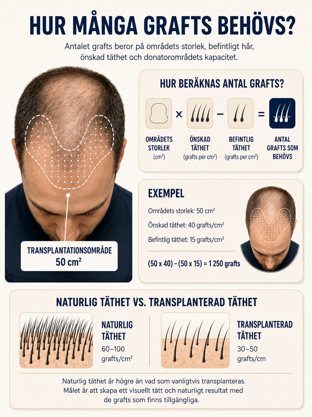 Hur många grafts behövs vid en hårtransplantation – och vad avgör antalet?