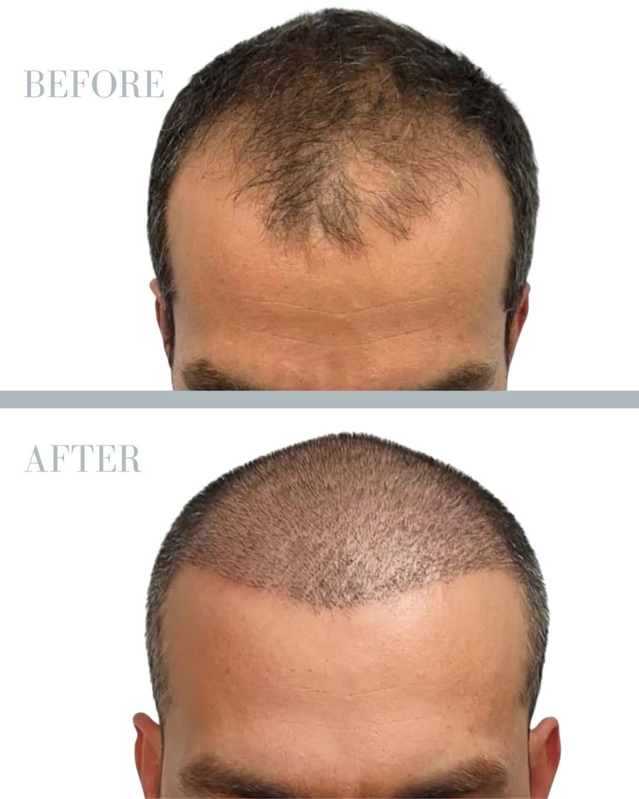 Före och efter - hårtransplantation 2500 grafts
