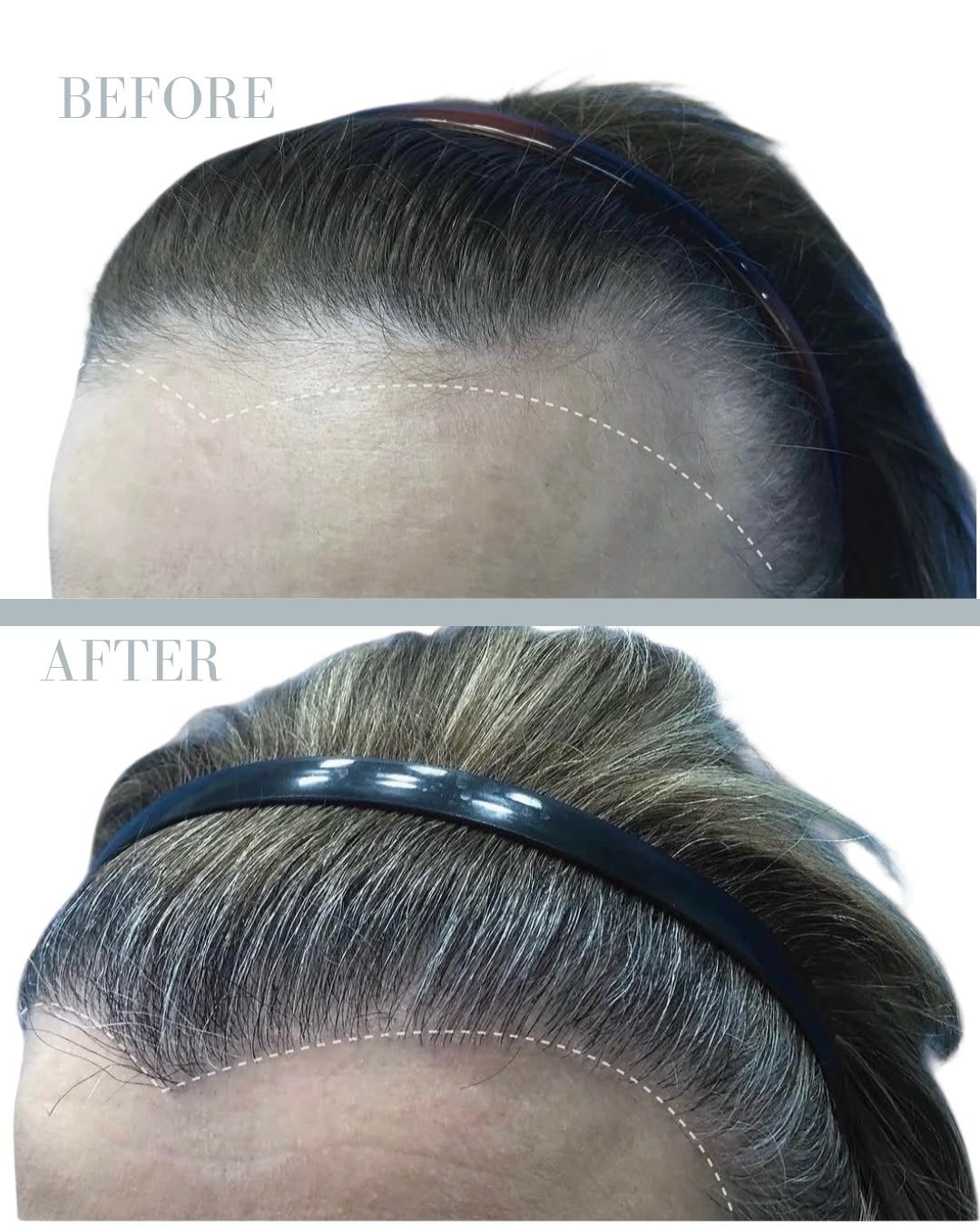Före och efter hårtransplantation — patient i ålder 18–29, resultat efter 12 mån.