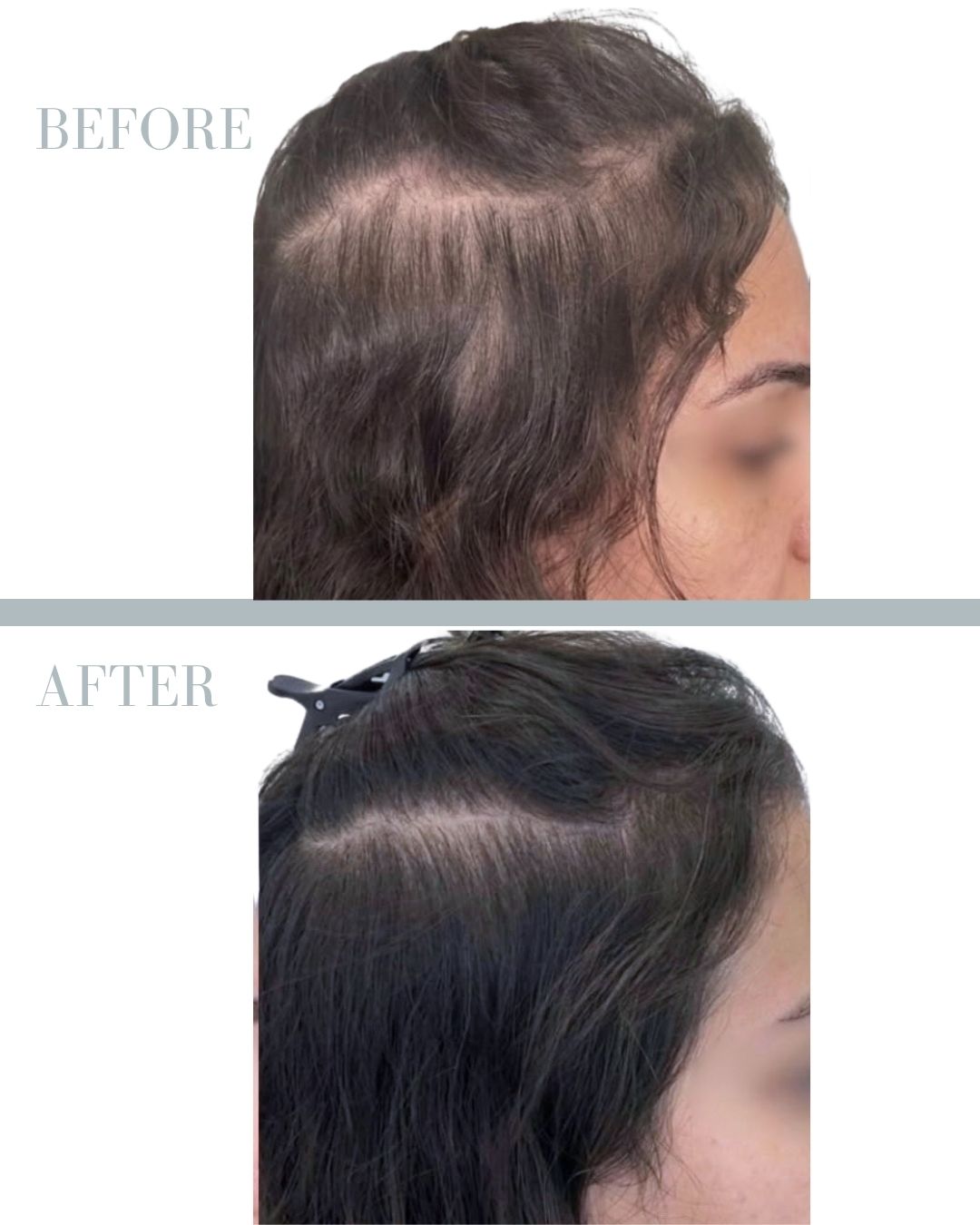 Before and after PRP.