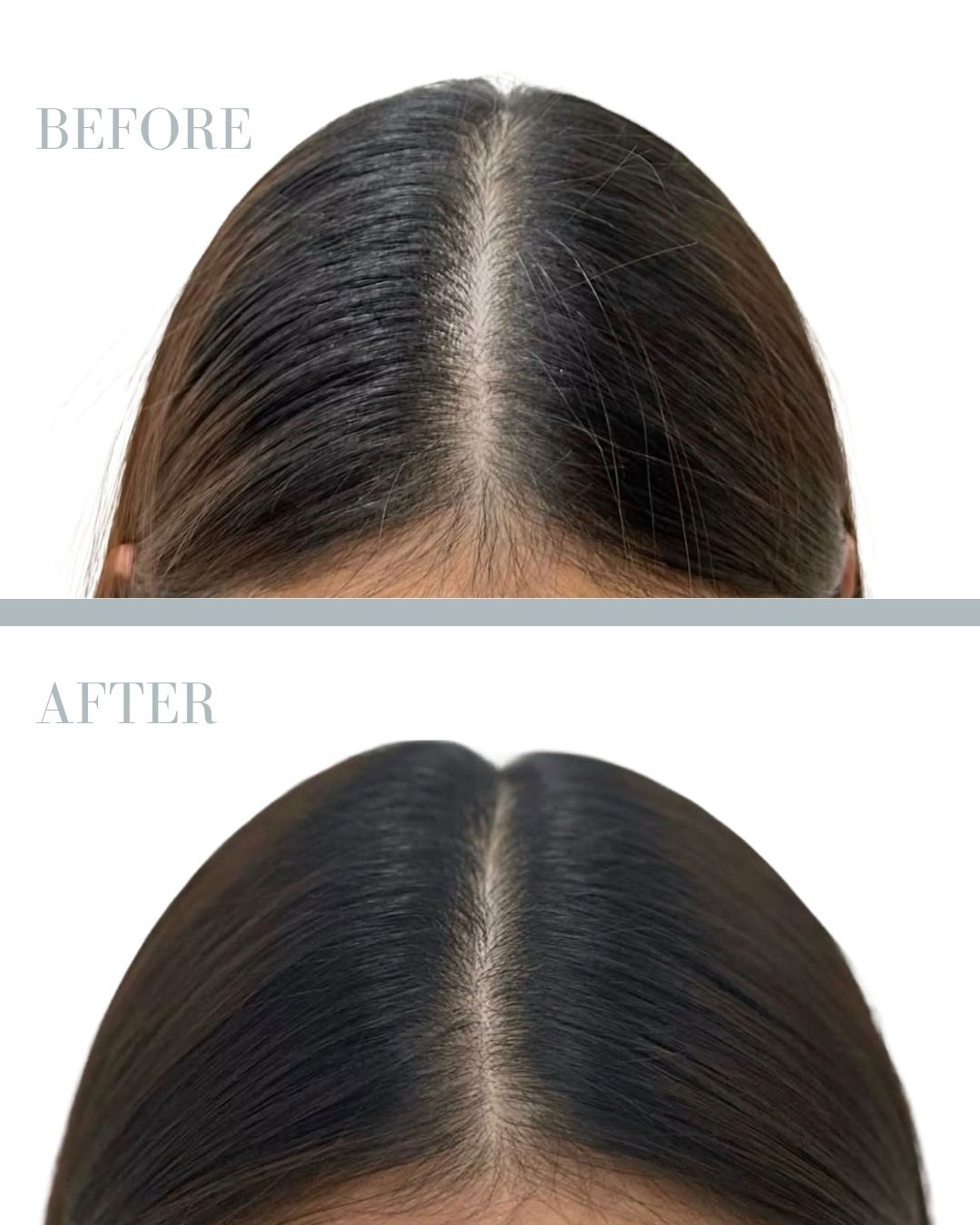 Before and after PRP.