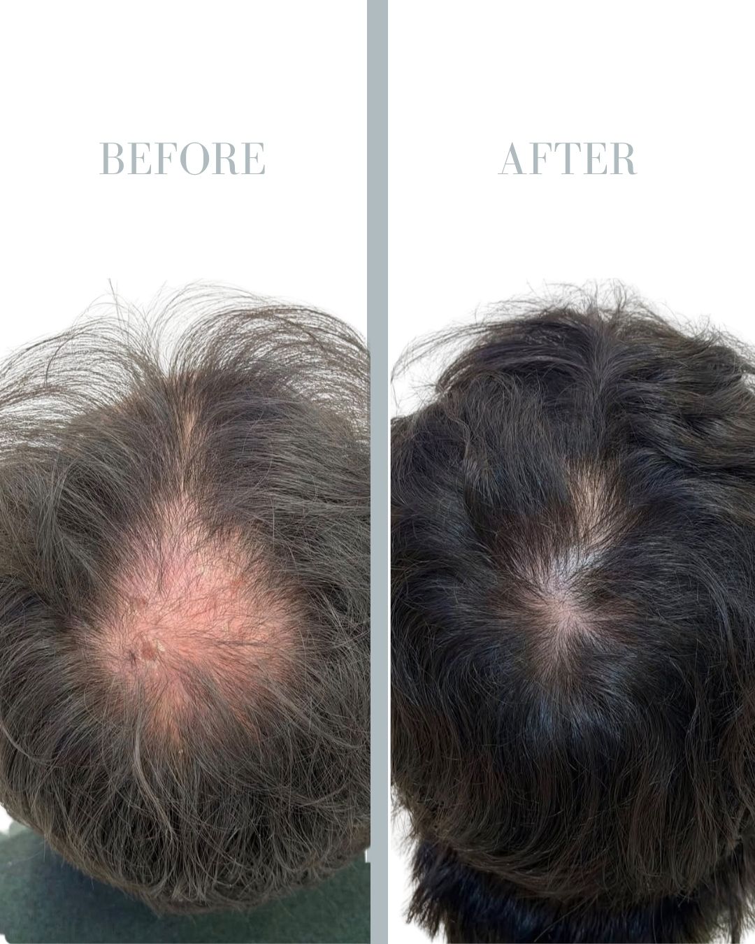 Before and after PRP.