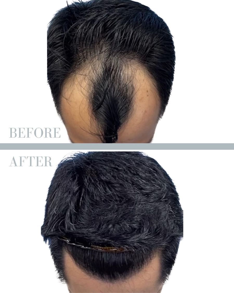 före efter hårtransplantation 3500 grafts