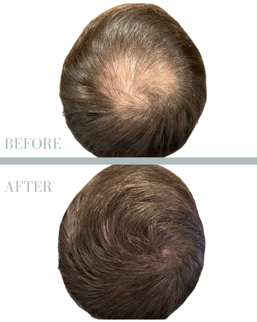 Före och efter hårtransplantation — patient i ålder 18–29, resultat efter 12 mån.