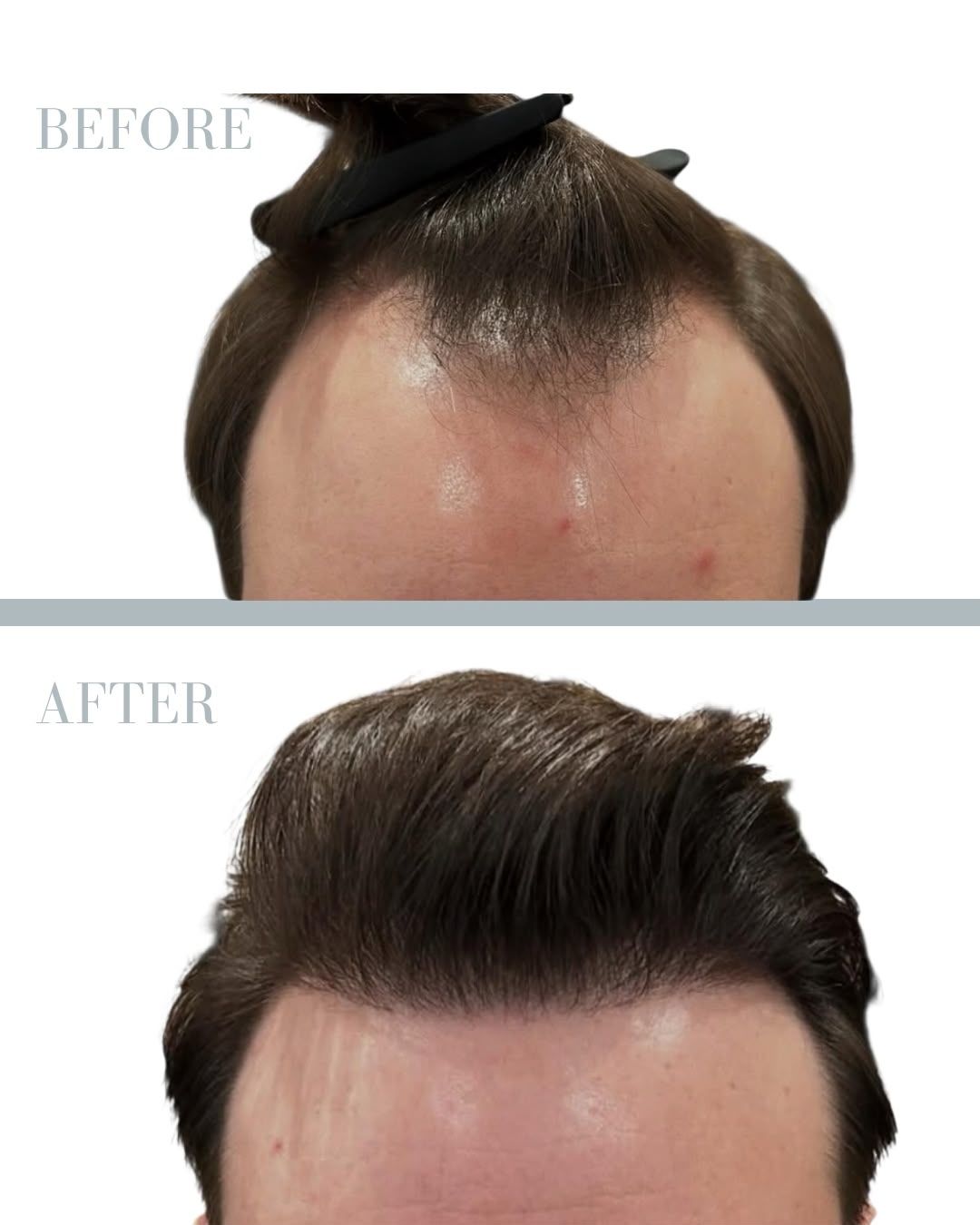 Före och efter hårtransplantation — patient i ålder 30–49, resultat efter 12 mån.