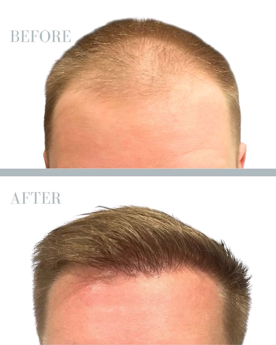 Före och efter — hårtransplantation, 2500 grafts