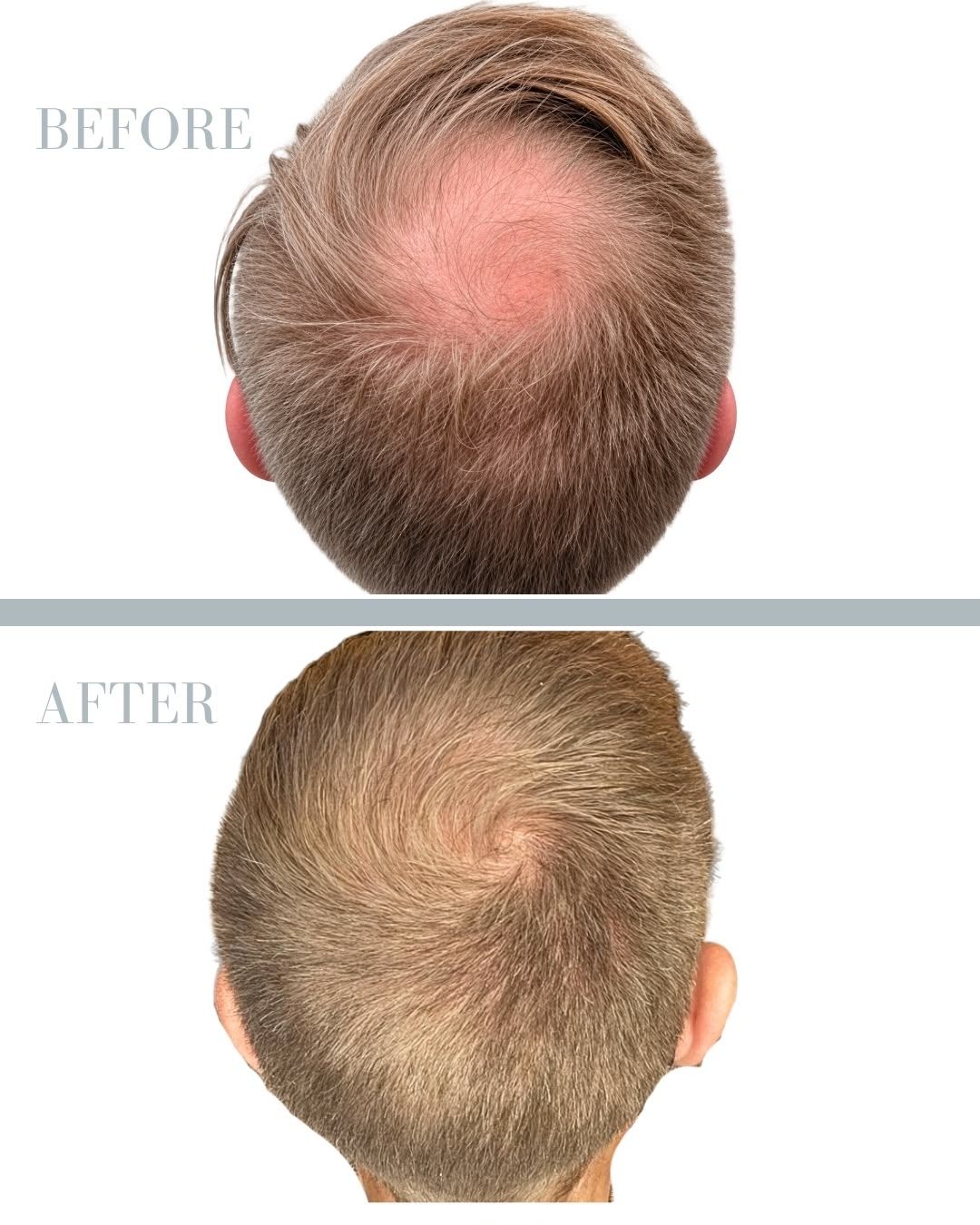 Före och efter hårtransplantation — patient i ålder 30–49, resultat efter 9 mån.