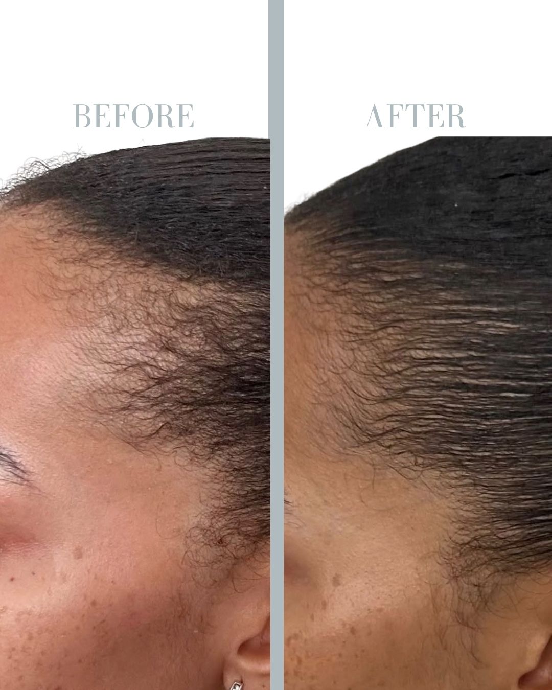 Before and after PRP.
