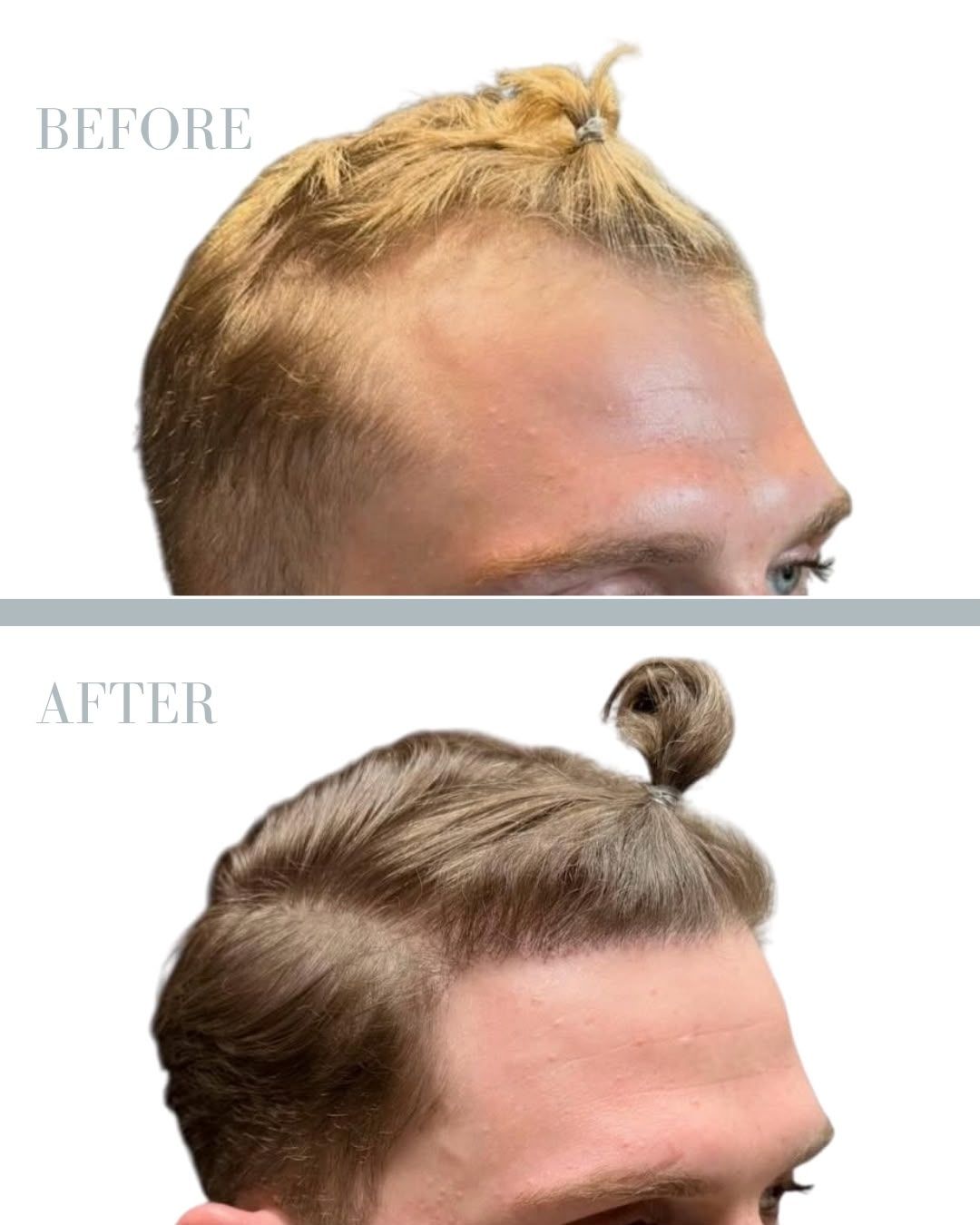Före och efter hårtransplantation — patient i ålder 30–49, resultat efter 12 mån.