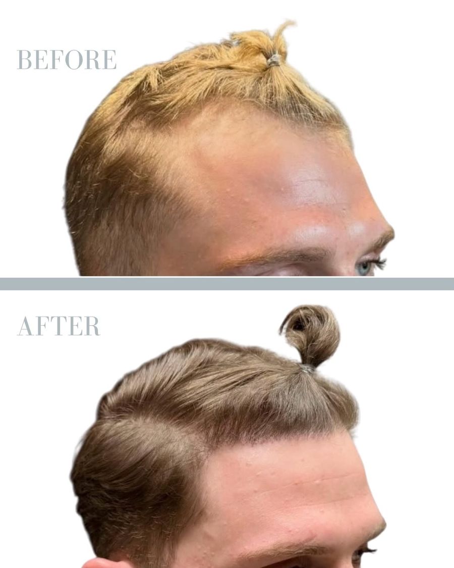 Före och efter — hårtransplantation, 2000 grafts