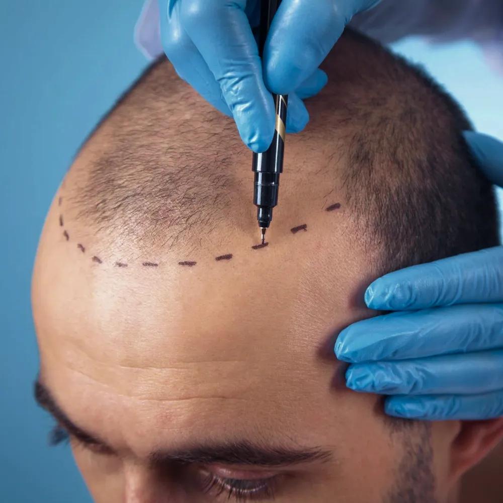 FUE-metoden — allt du behöver veta om modern hårtransplantation