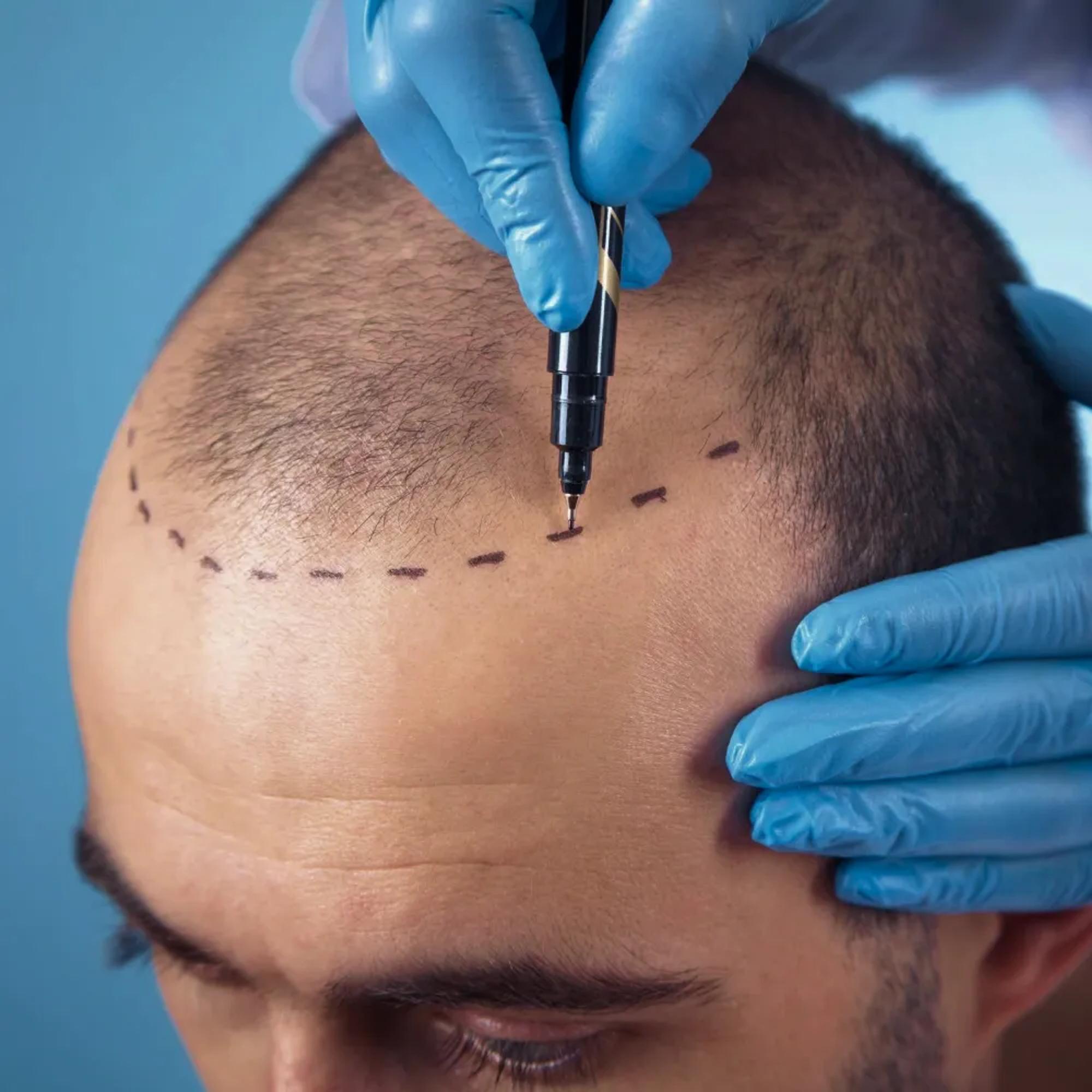 FUE-metoden — allt du behöver veta om modern hårtransplantation